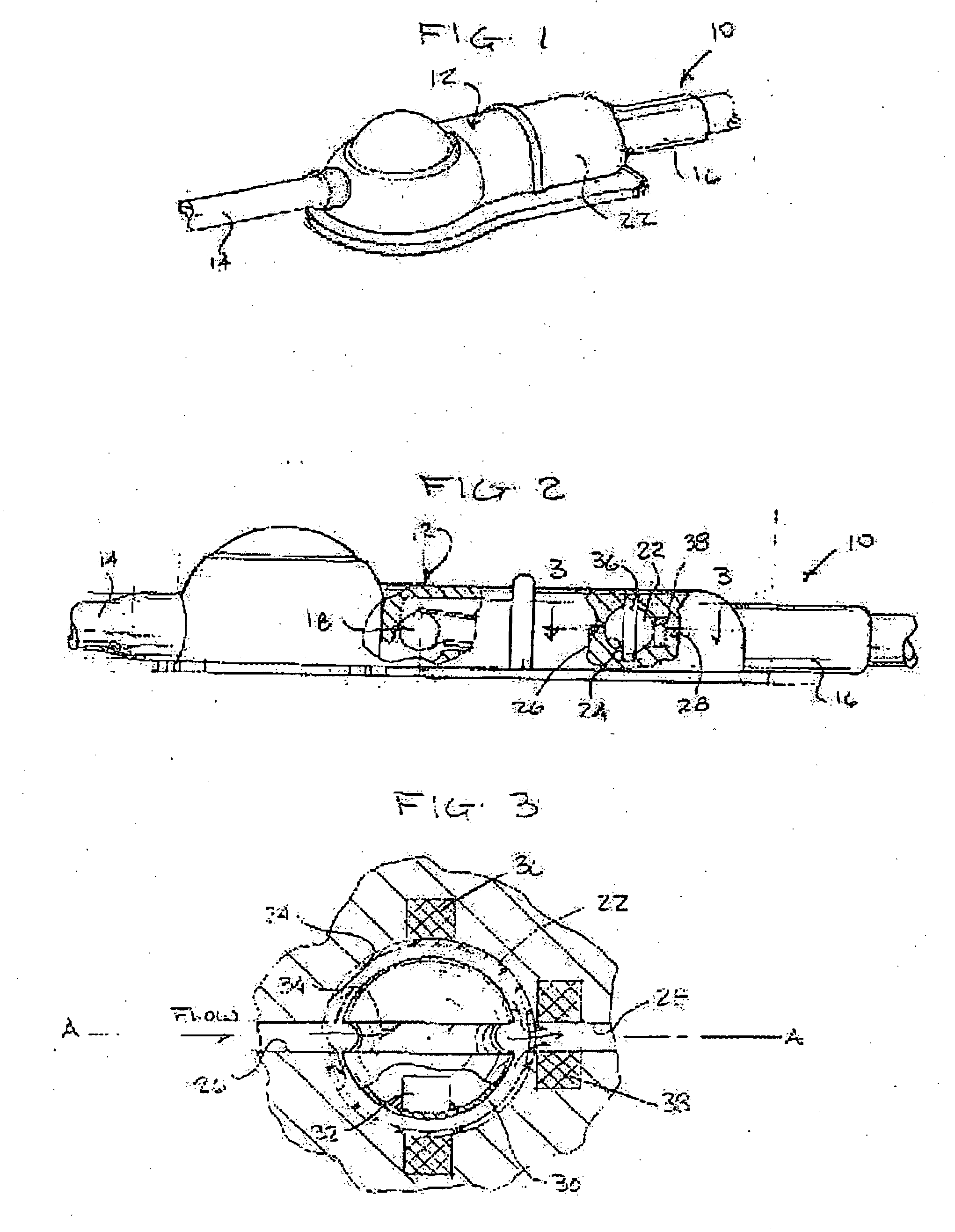 Shunt system including a flow control device for controlling the flow of cerebrospinal fluid out of a brain ventricle