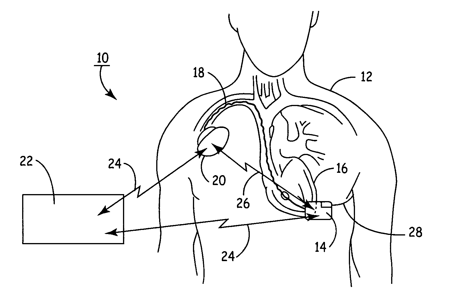 Remotely enabled pacemaker and implantable subcutaneous cardioverter/defibrillator system