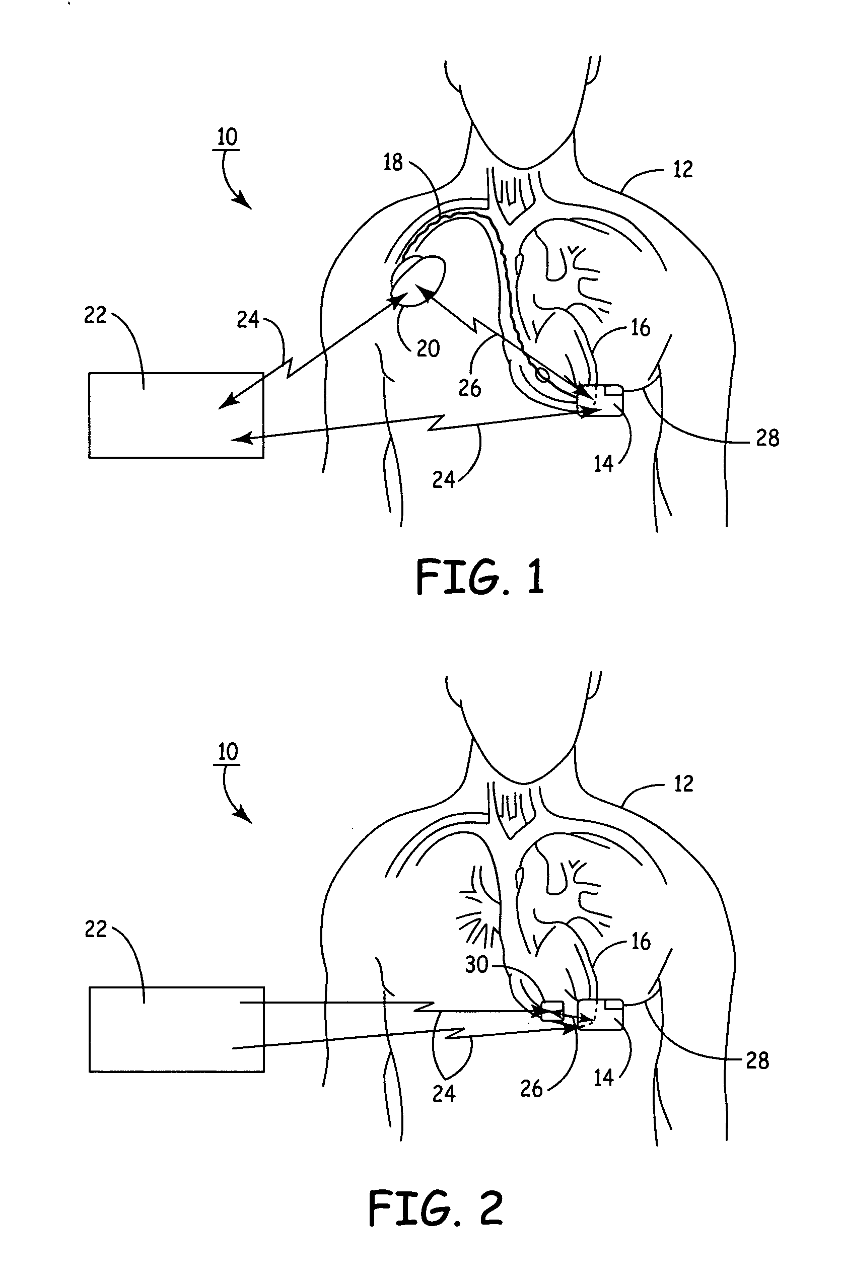 Remotely enabled pacemaker and implantable subcutaneous cardioverter/defibrillator system