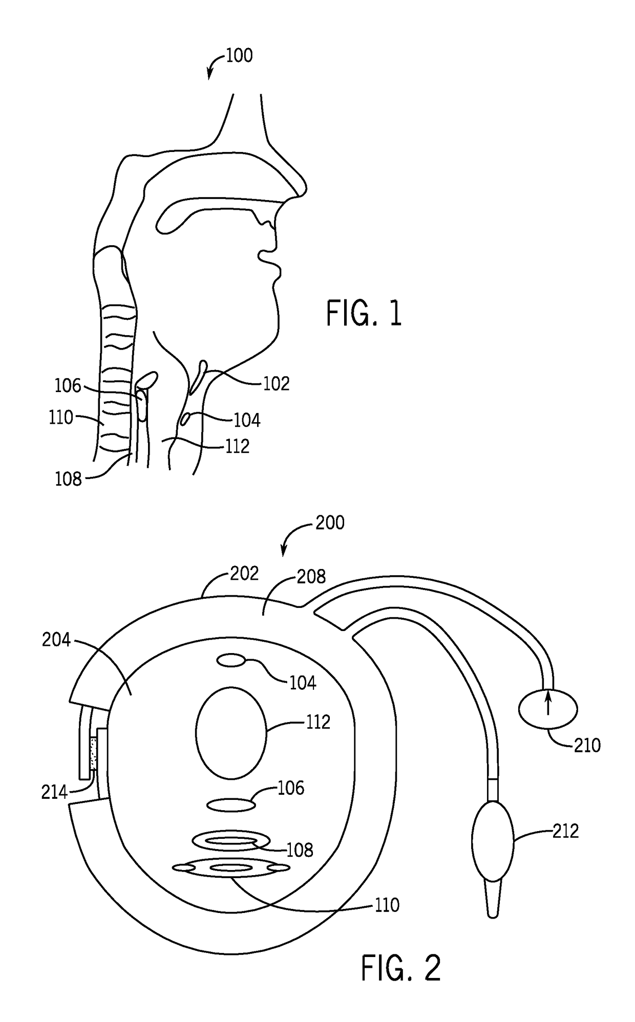 Compression Device and Pressure Sensor for Treatment of Abnormal Upper Esophageal Sphincter Functionality