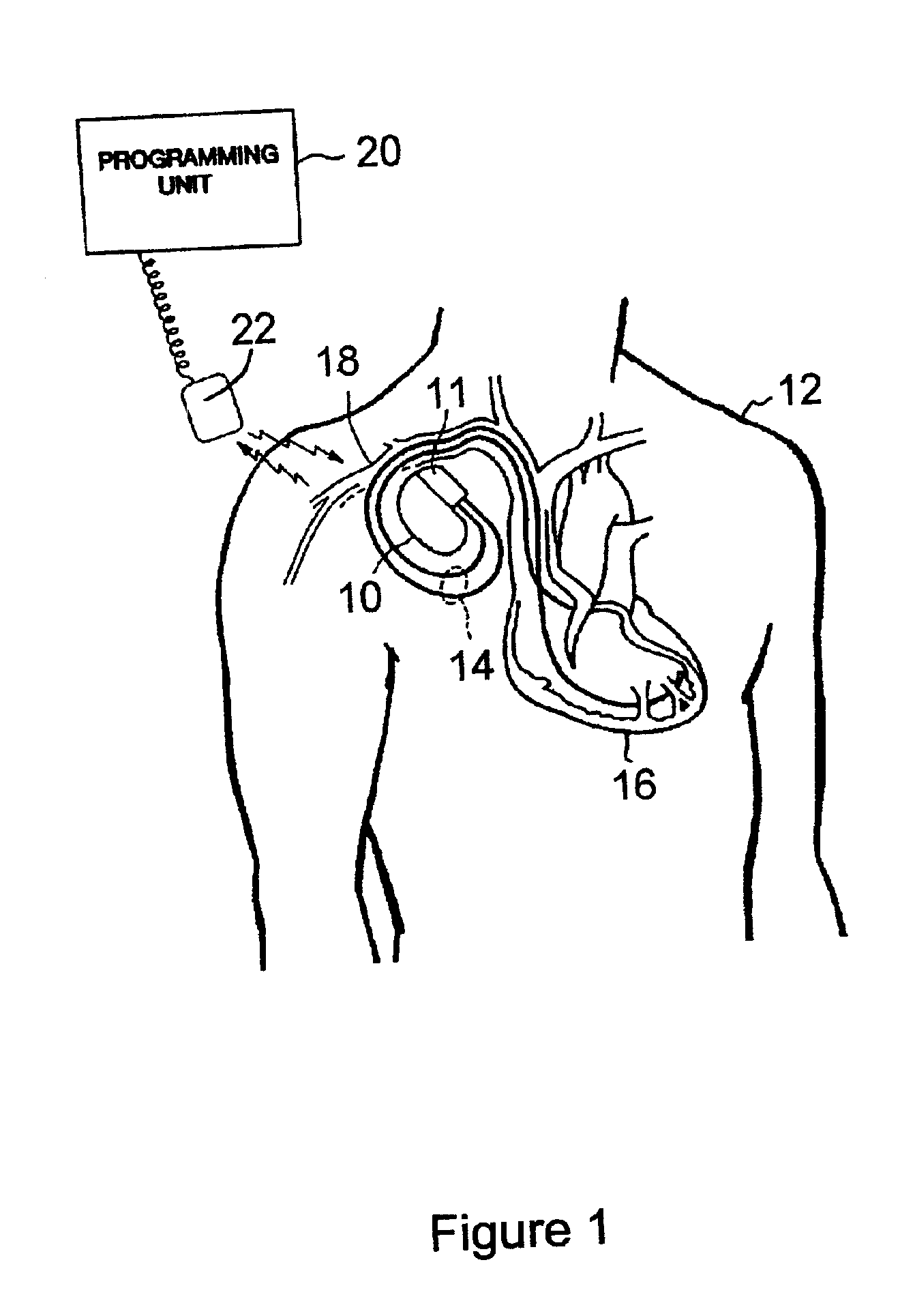 Implanted medical device telemetry using integrated thin film bulk acoustic resonator filtering