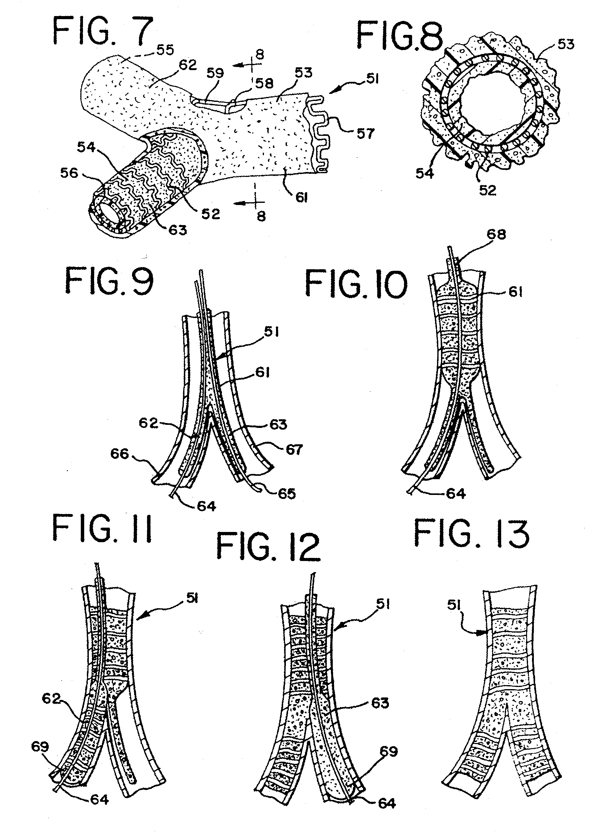 Expandable supportive branched endoluminal grafts