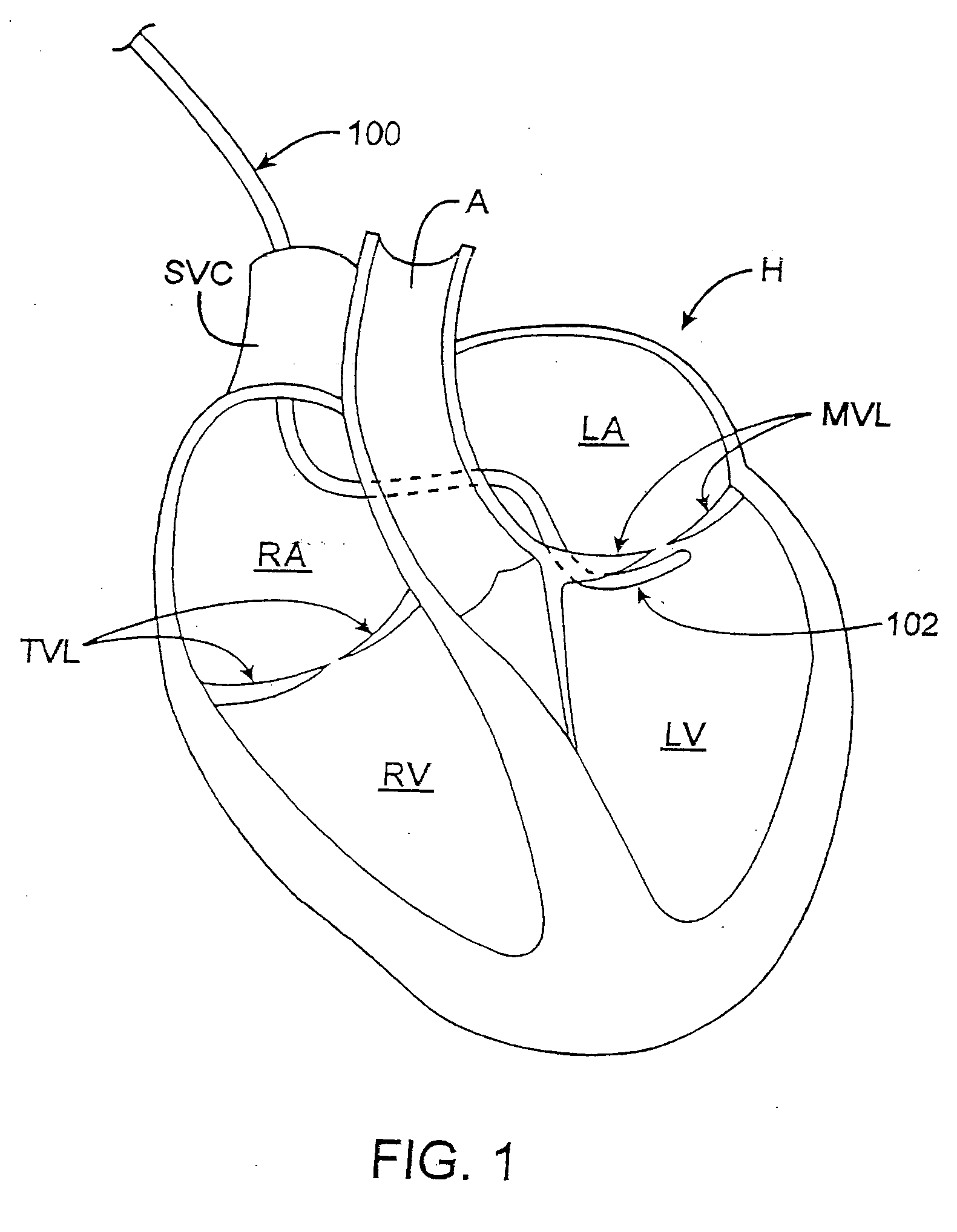 Remodeling a cardiac annulus