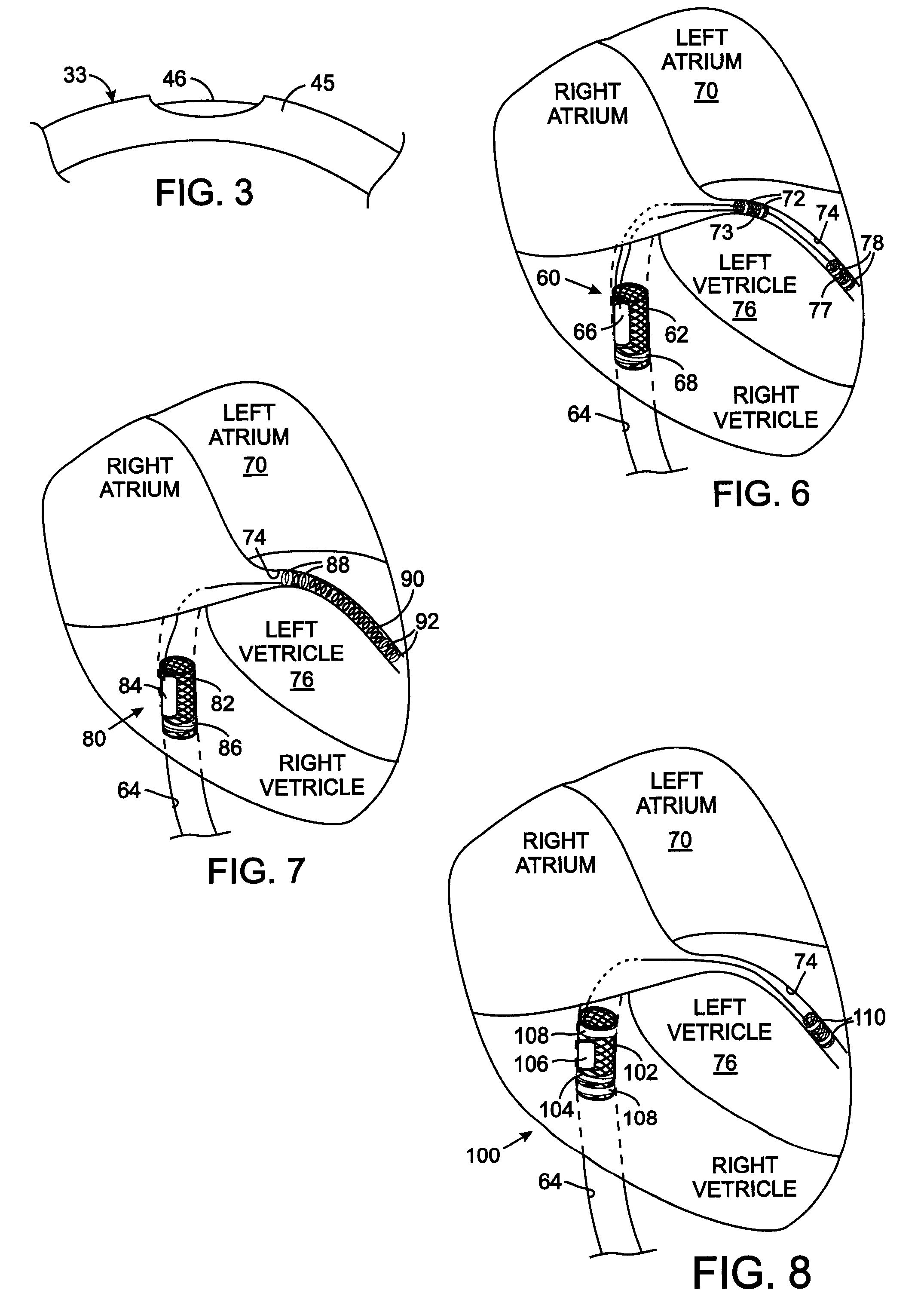 Intravascular Electronics Carrier Electrode for a Transvascular Tissue Stimulation System