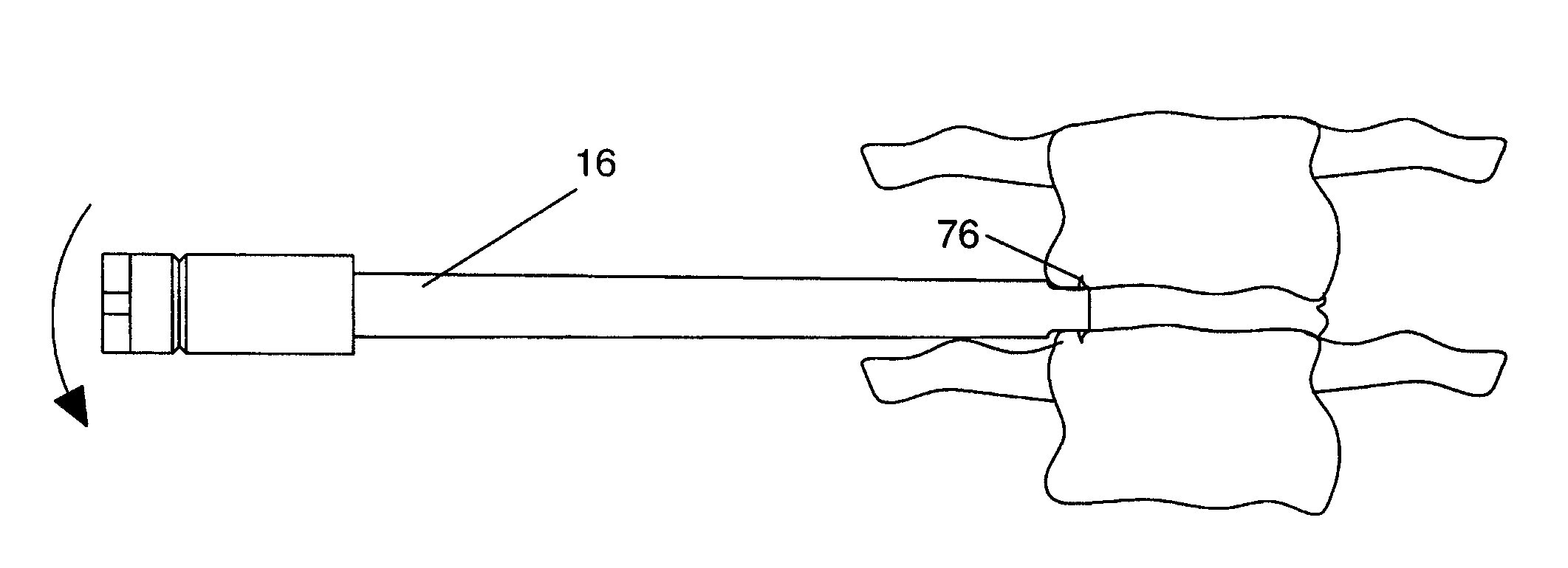 Access assembly for anterior and lateral spinal procedures