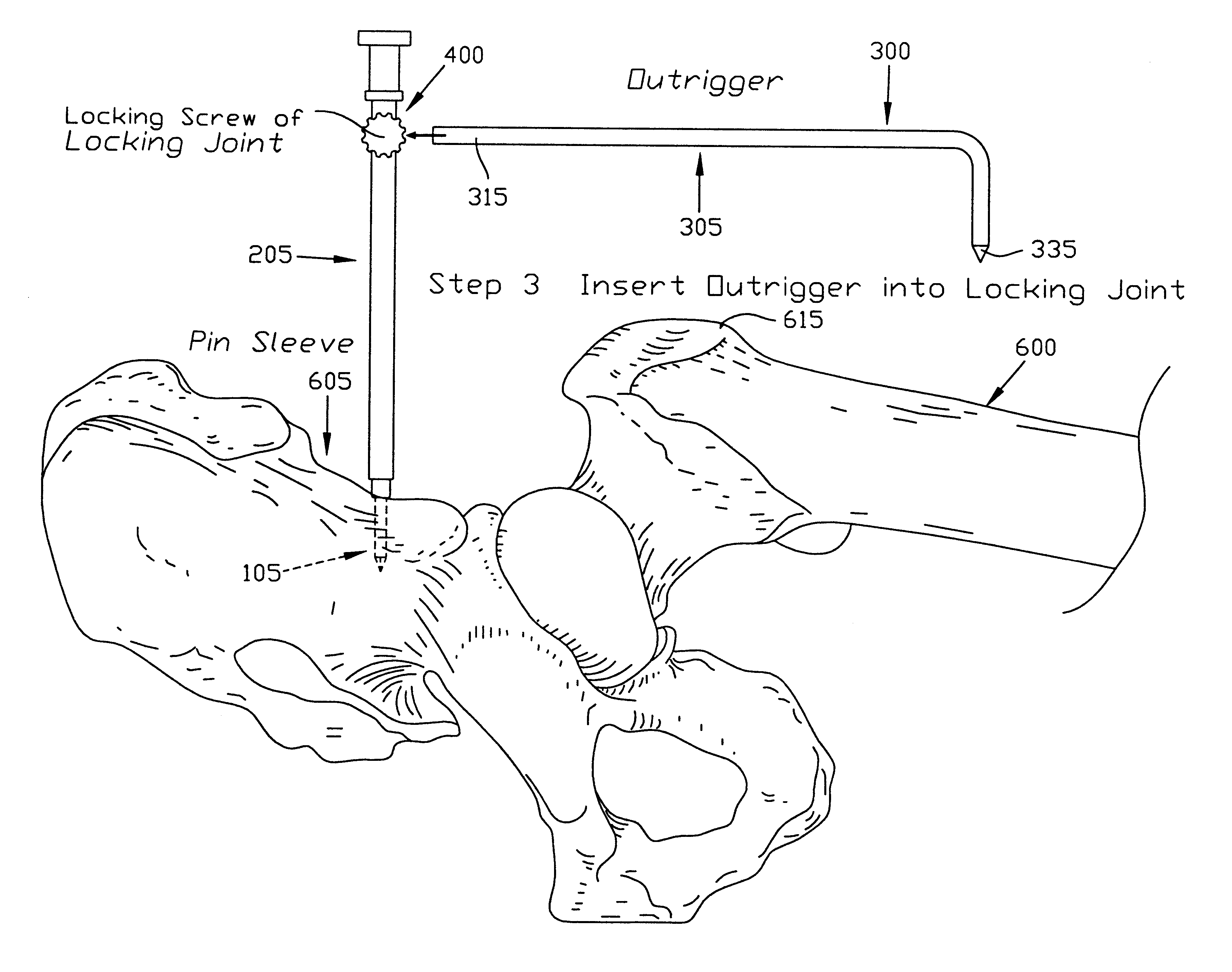 Apparatus and method for determining the relative position of bones during surgery