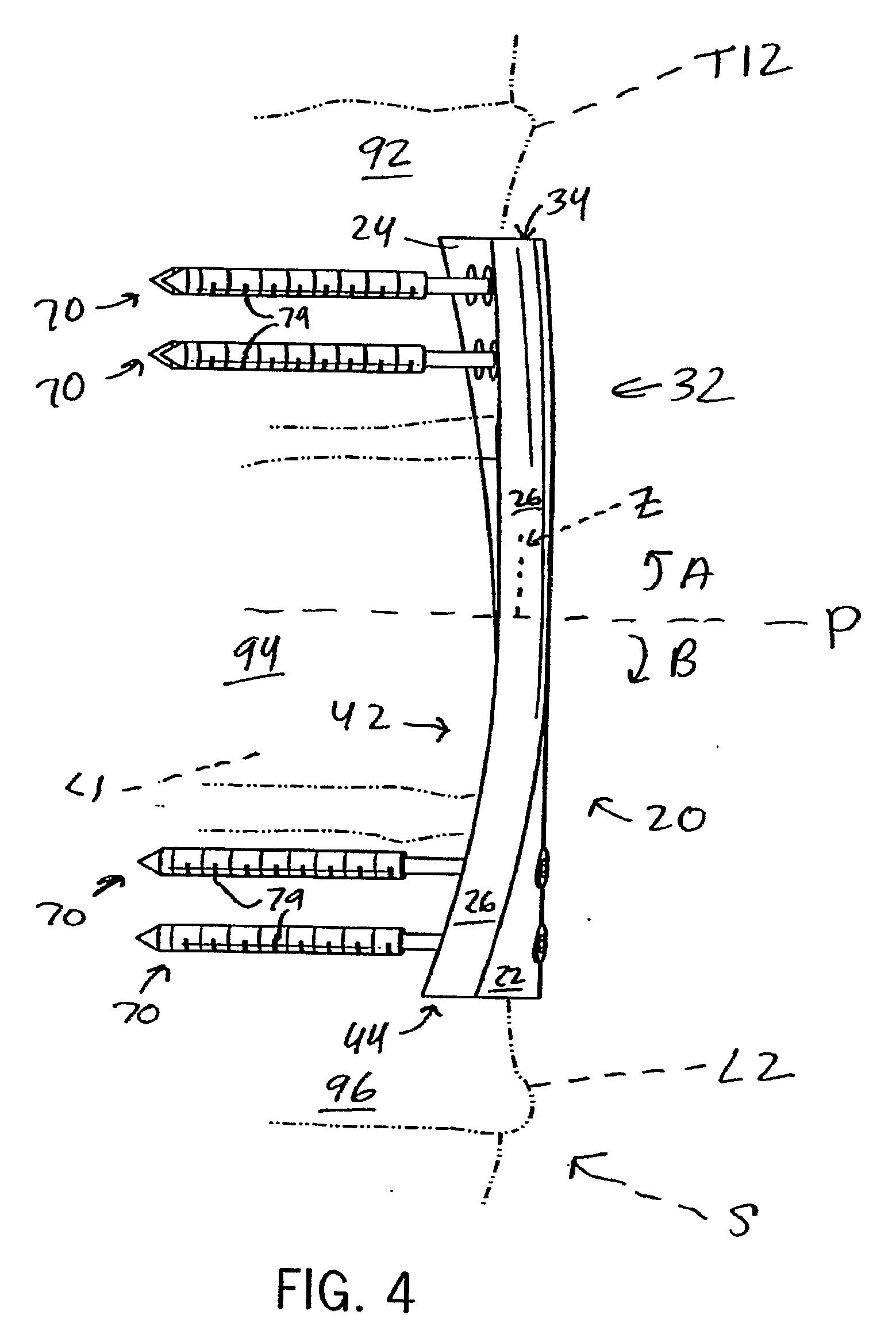 Anterior Adherent Thoracolumbar Spine Plate