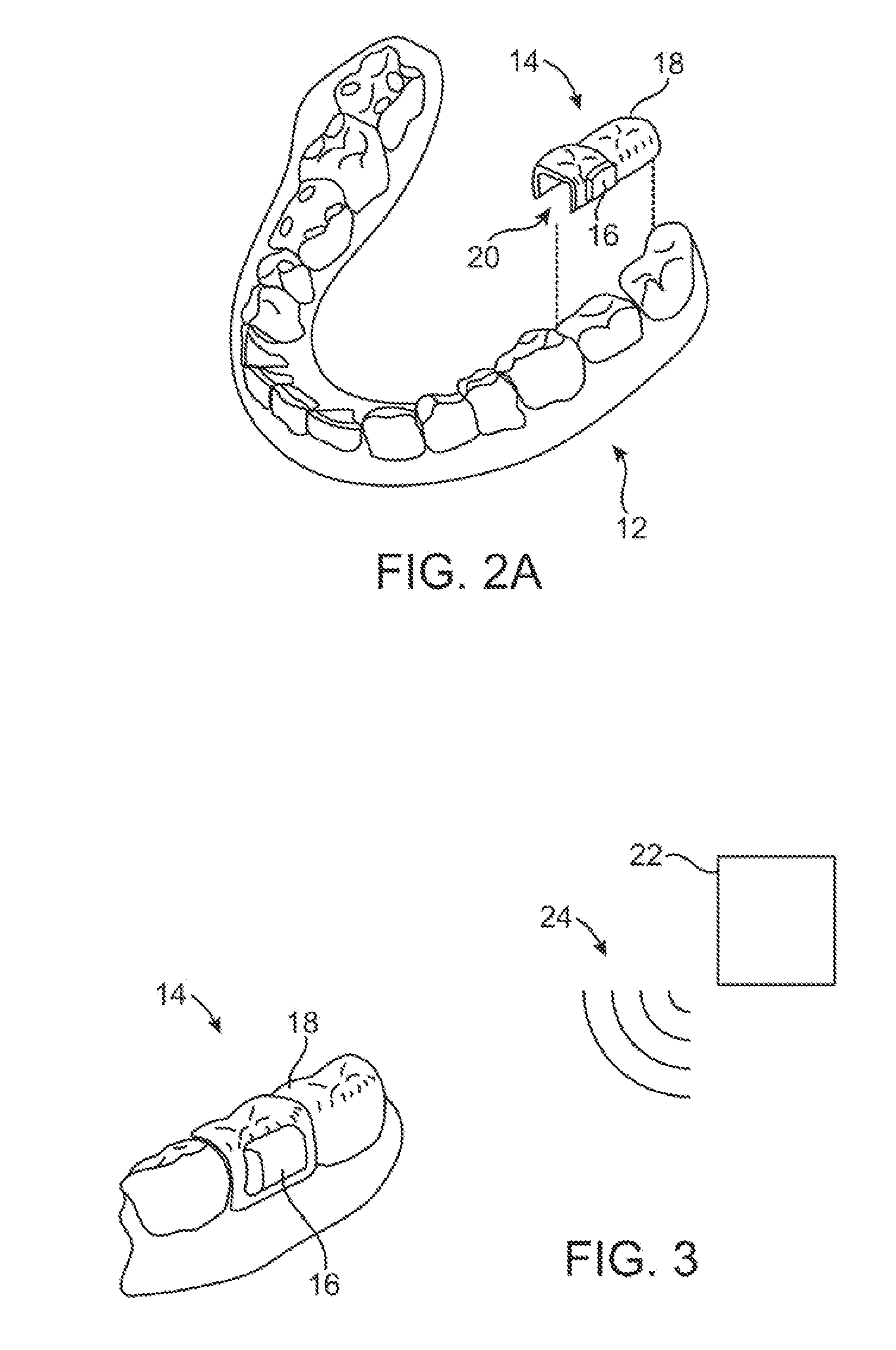Methods and apparatus for treating tinnitus