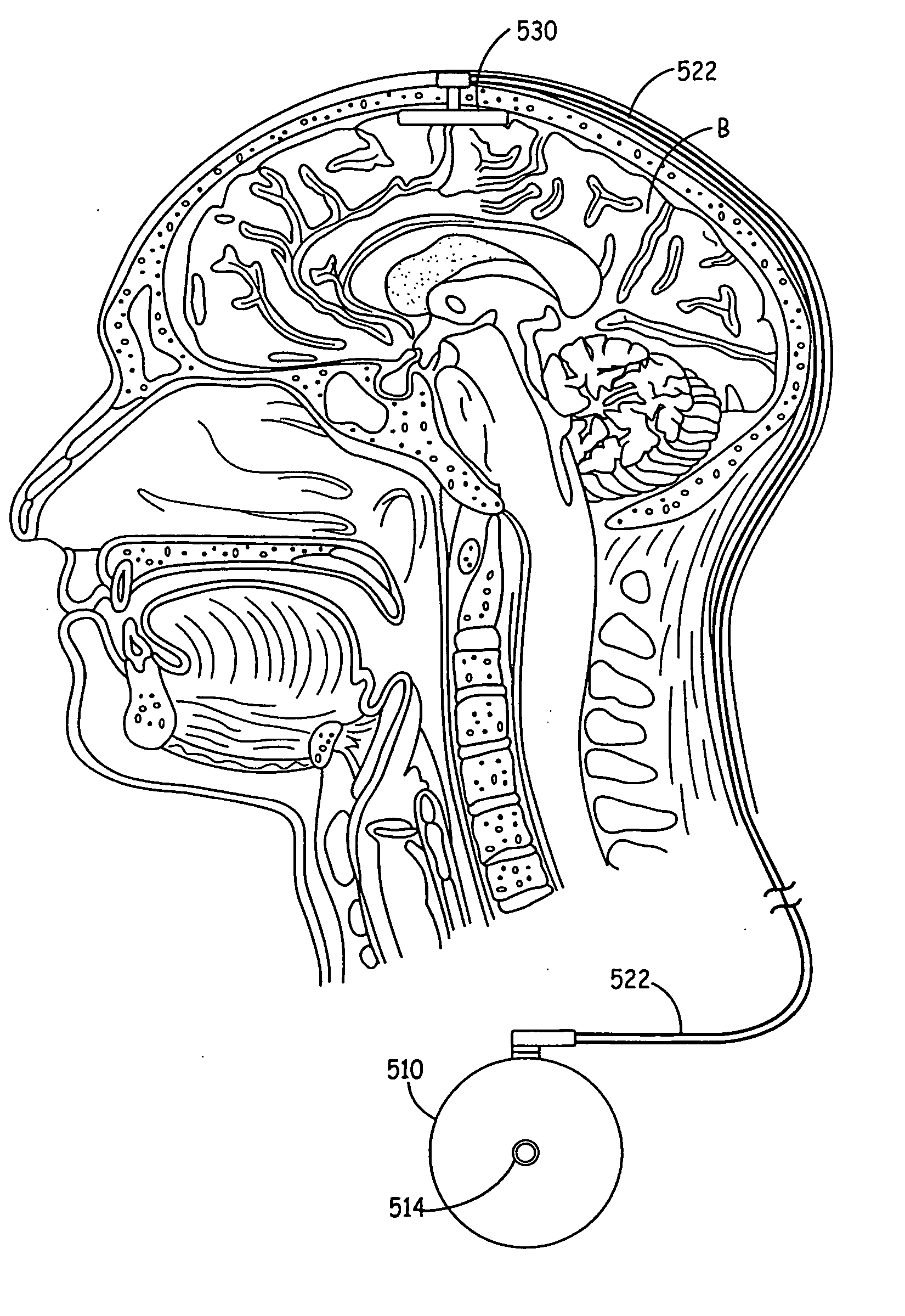 Anchoring of a medical device component adjacent a dura of the brain or spinal cord
