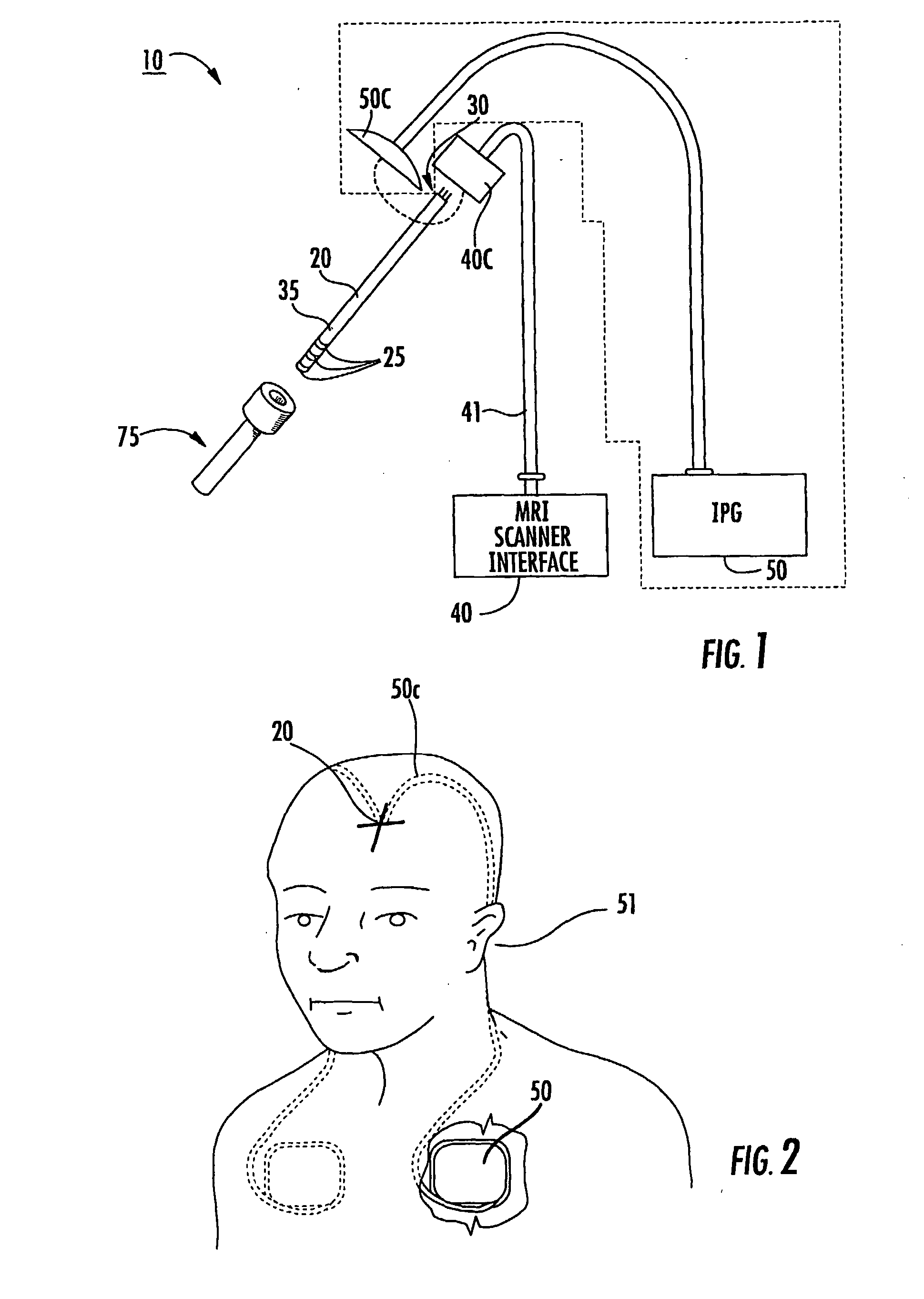 Implantable Mri compatible Stimulation Leads And Antennas And Related Systems And Methods