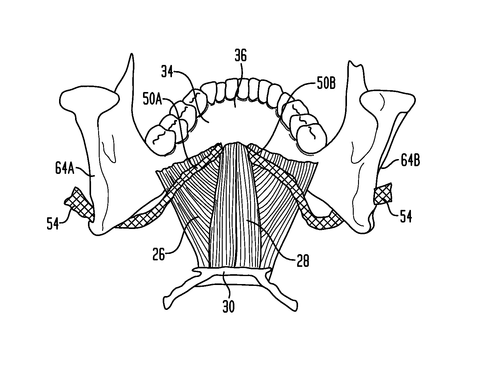 Methods and devices for the indirect displacement of the hyoid bone for treating obstructive sleep apnea