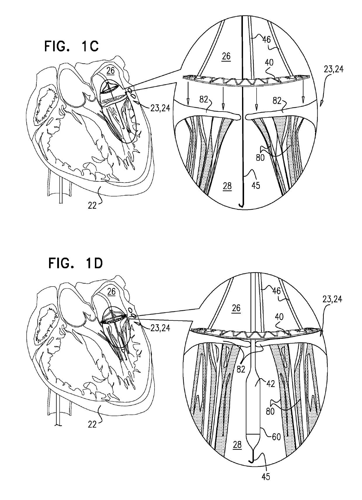 Techniques for percutaneous mitral valve replacement and sealing