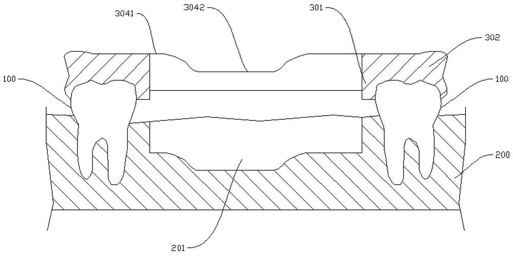 Implant tooth guide plate assembly and implant grooving method
