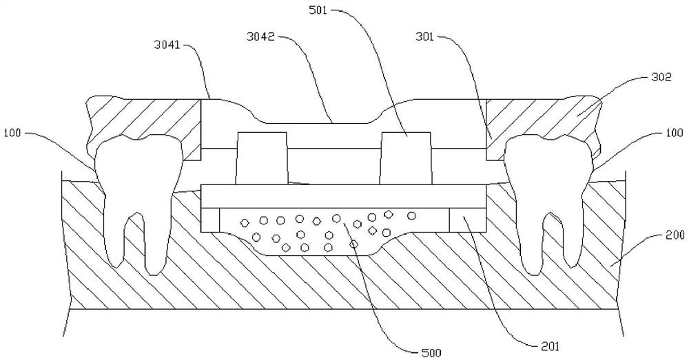 Implant tooth guide plate assembly and implant grooving method