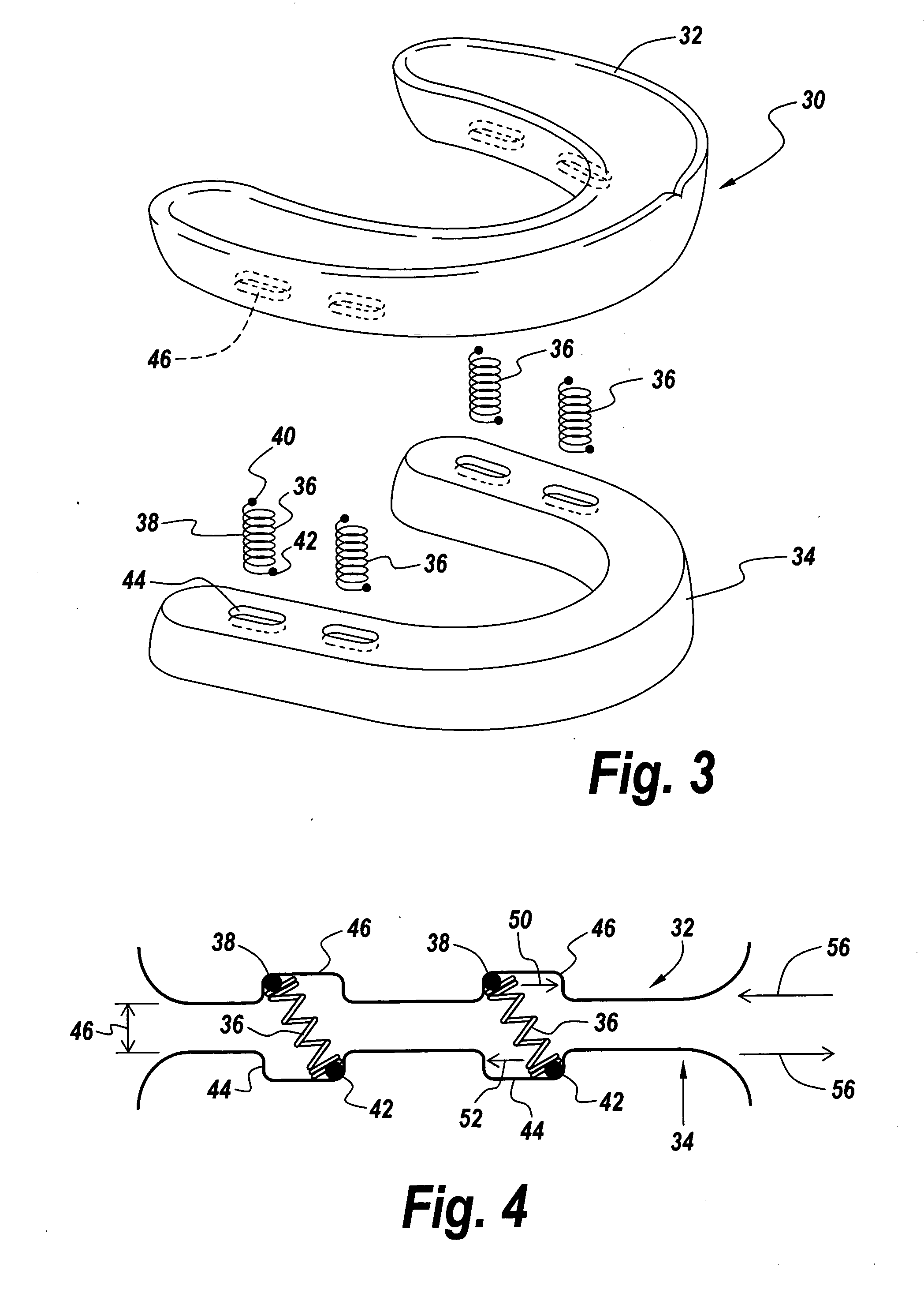 Method and apparatus for protecting teeth, preventing the effects of bruxism and protecting oral structures from sports injuries