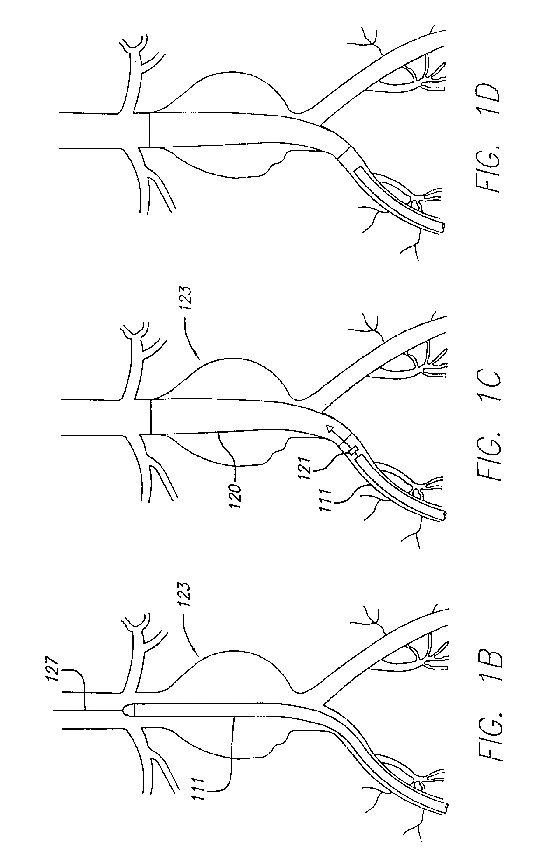 Staged endovascular graft delivery system