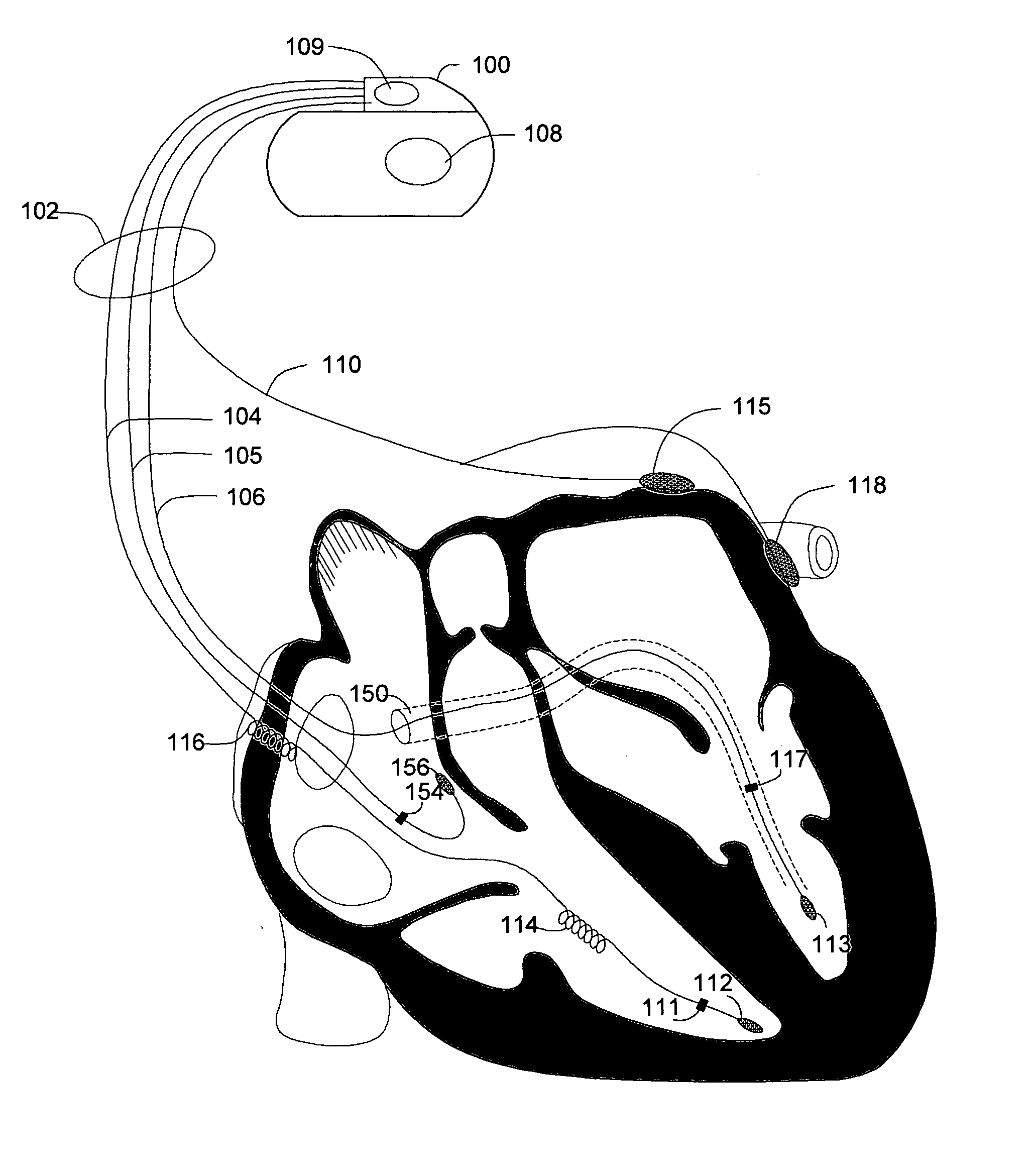 Dynamic morphology based atrial automatic threshold