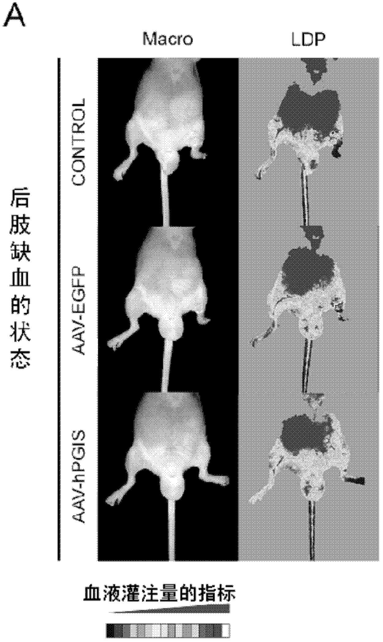 Drug composition for angiogenesis therapy