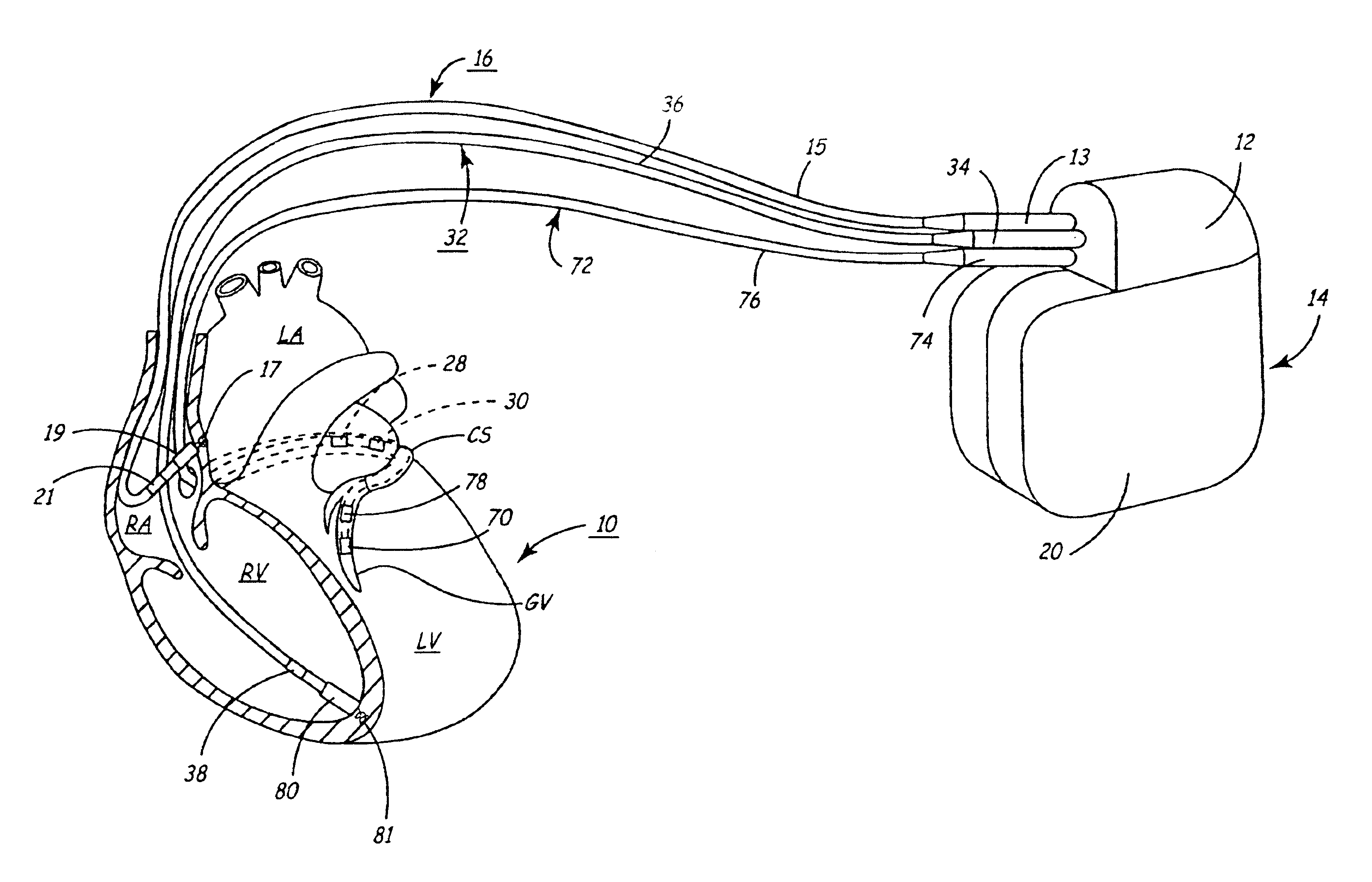 Enhanced method and apparatus to identify and connect a small diameter lead with a low profile lead connector