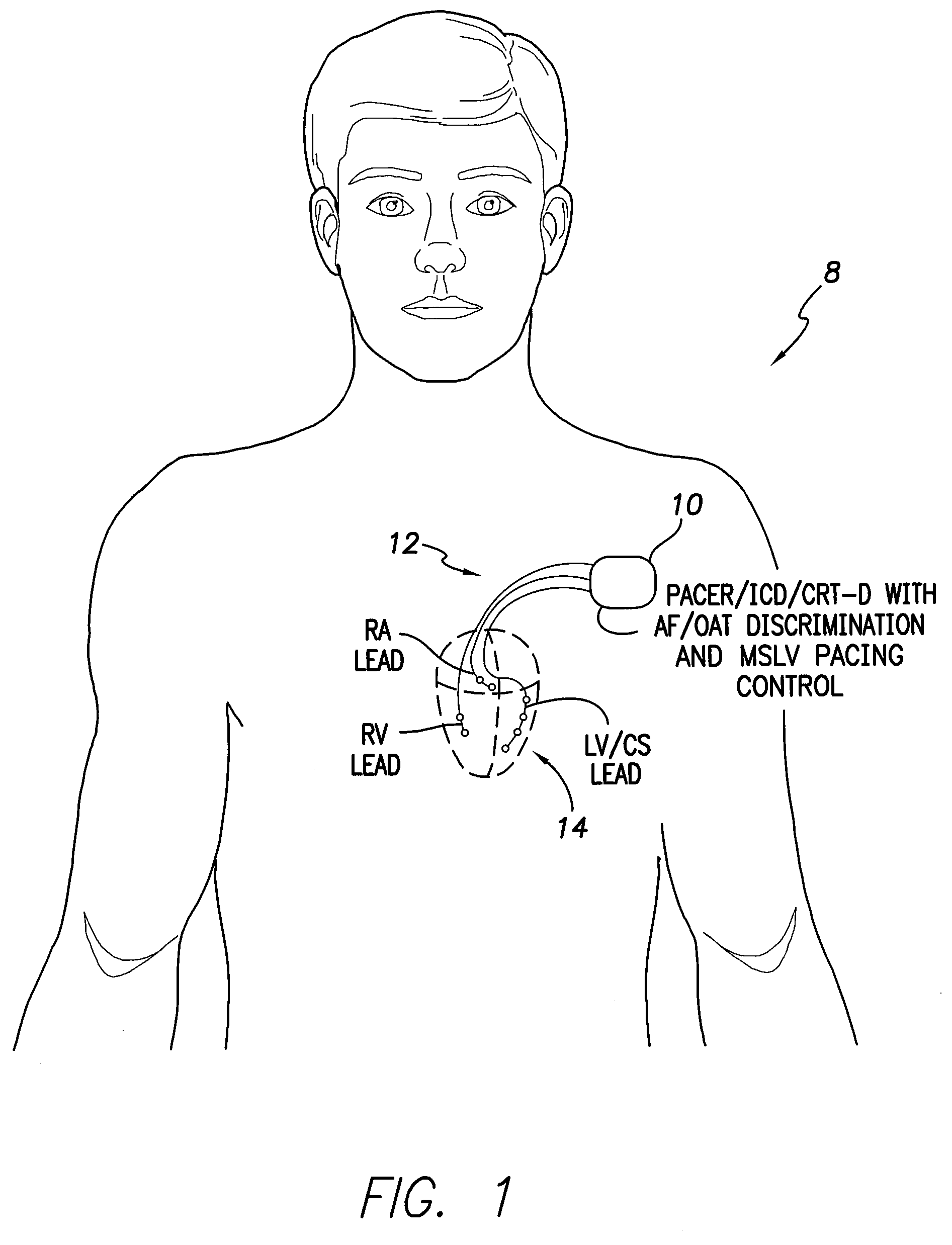 Systems and methods for use by an implantable medical device for controlling multi-site CRT pacing in the presence of atrial tachycardia