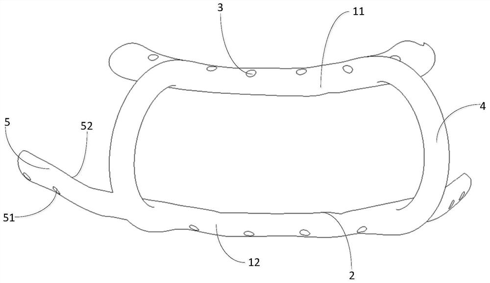 An in-place guide plate applied to multi-segment fibula double stack reconstruction of mandible