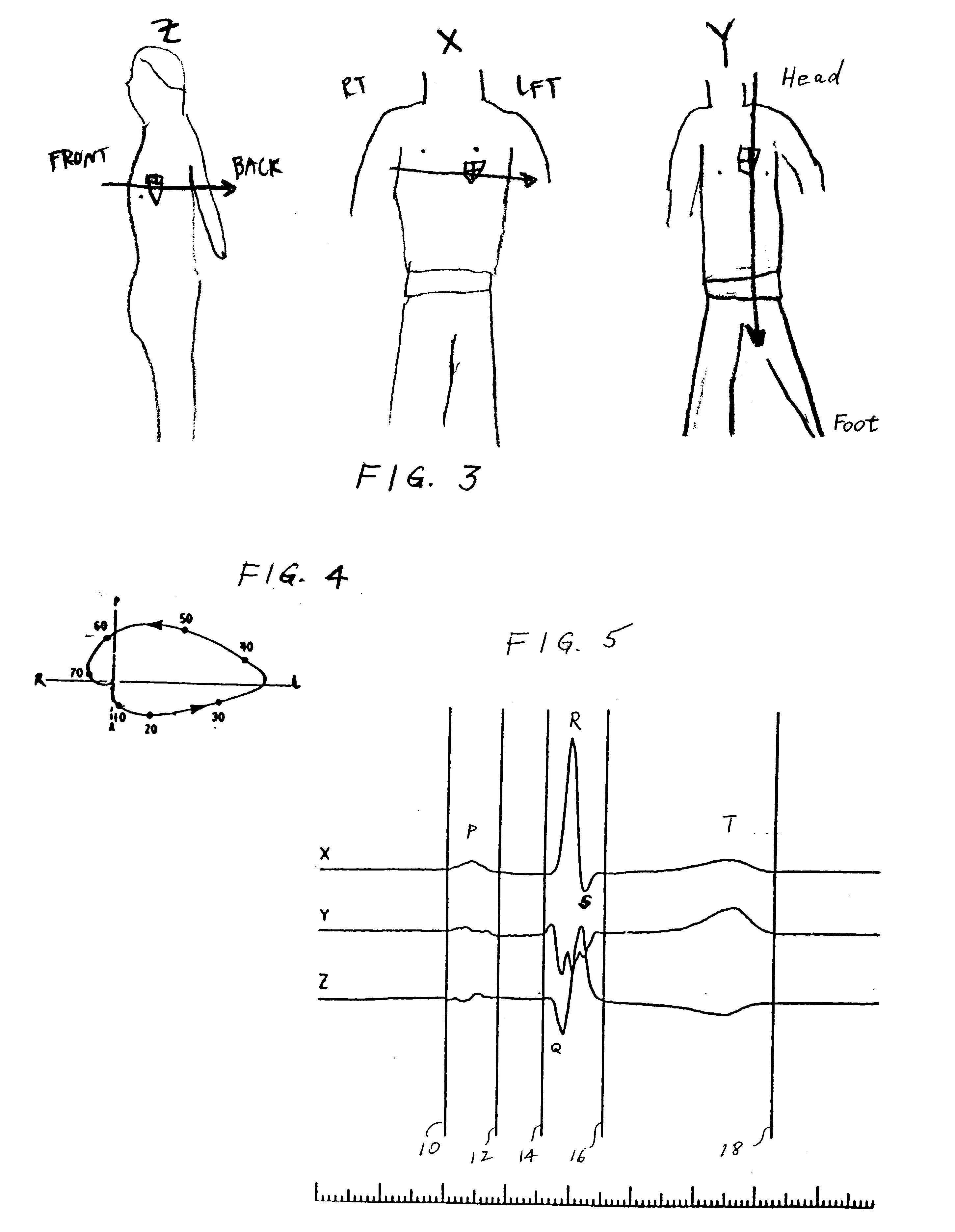 Method of analysis of the electrocardiogram
