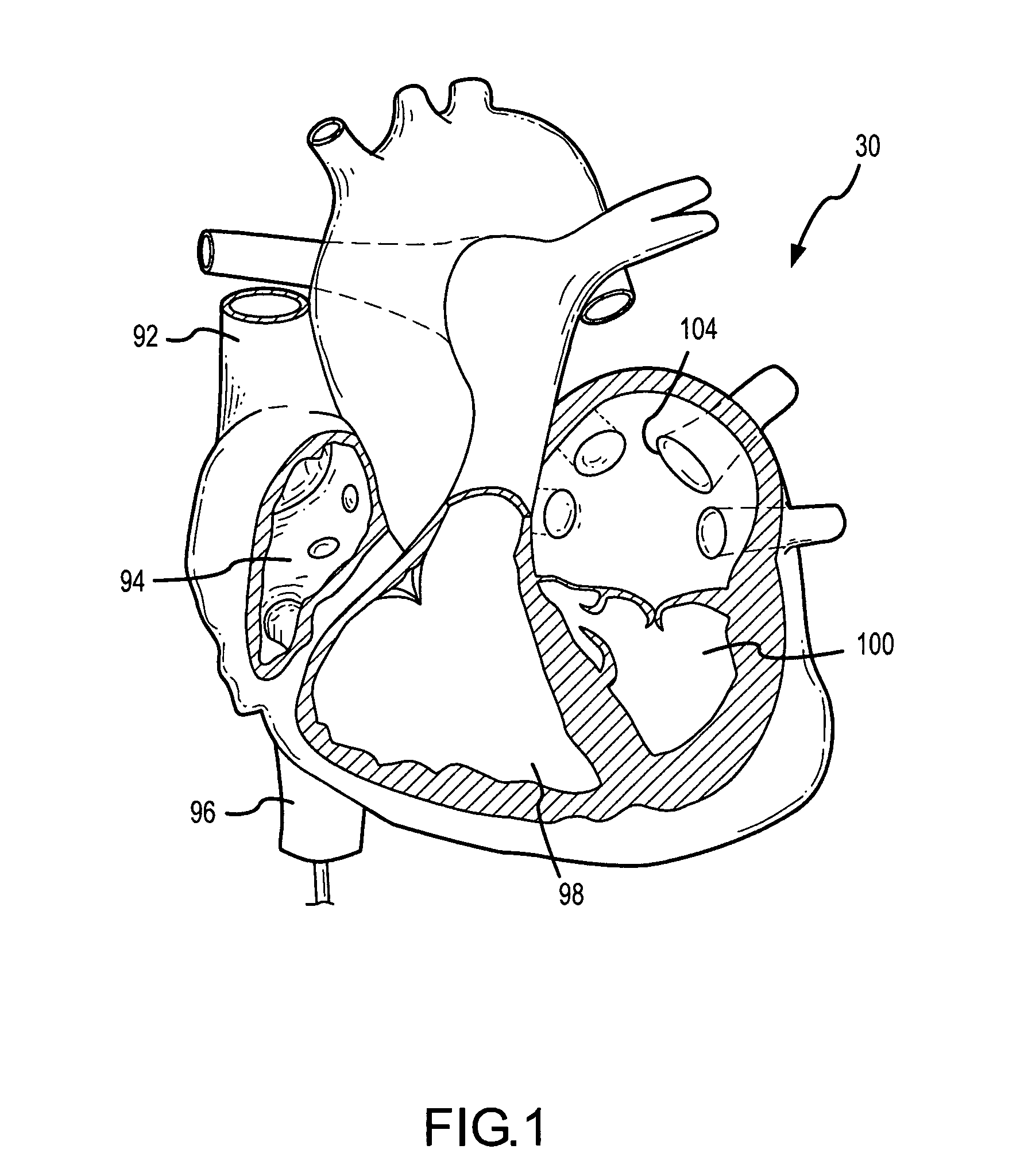 Position independent catheter