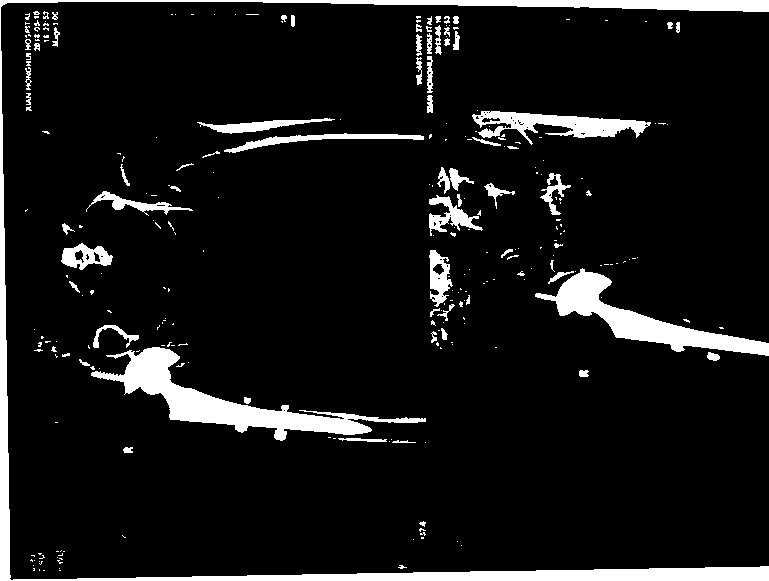 Traumatic injury drug and preparation method thereof