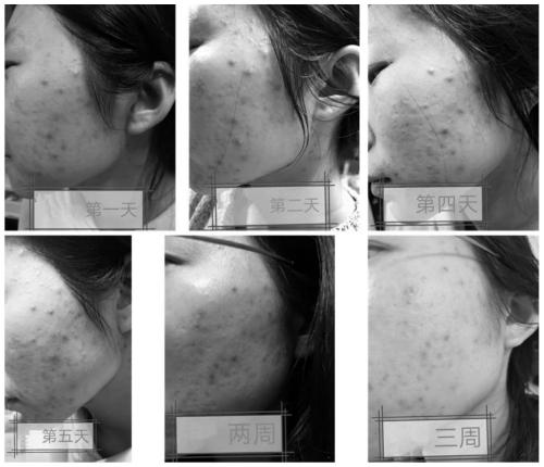 Acne-removing composition and application thereof