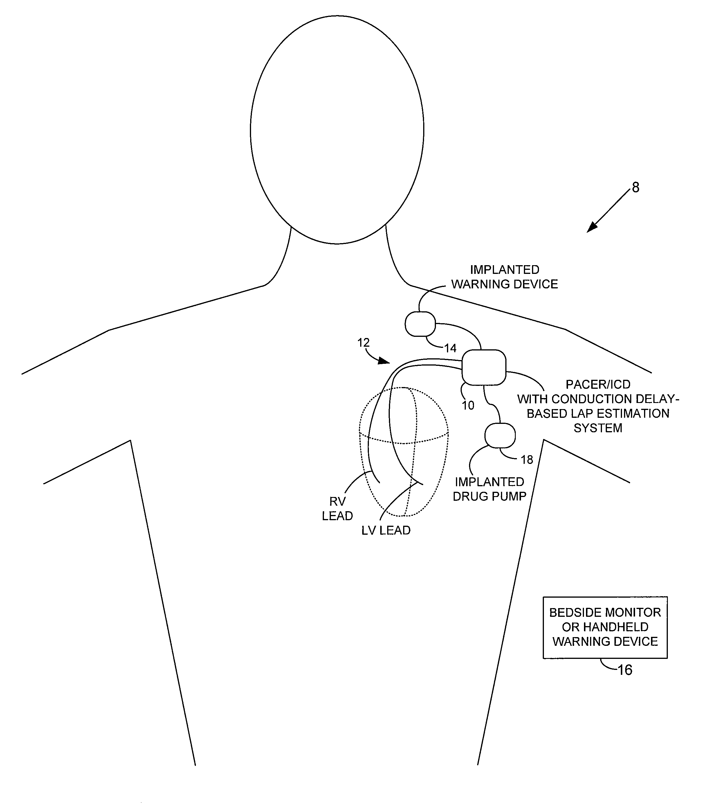 System and method for estimating electrical conduction delays from immittance values measured using an implantable medical device