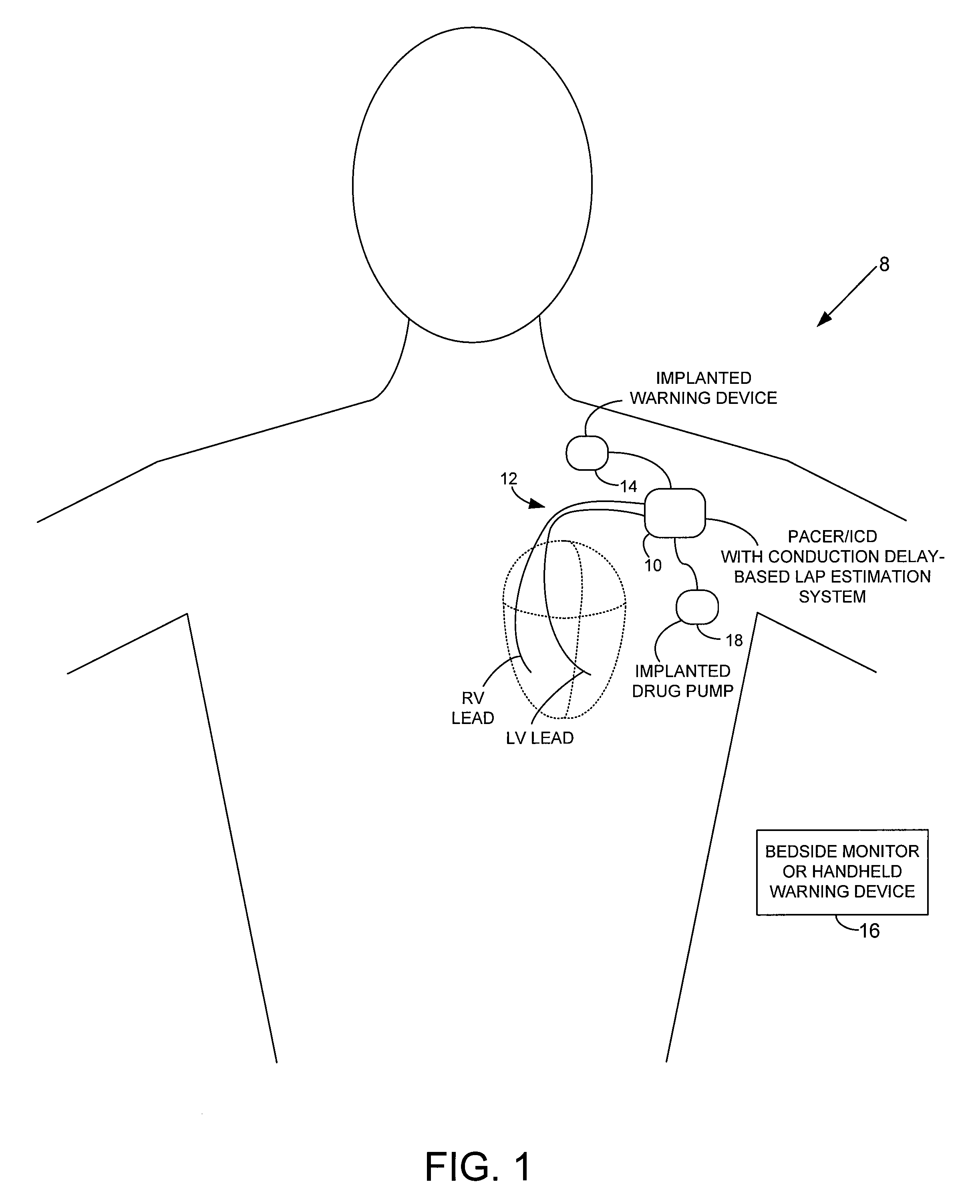 System and method for estimating electrical conduction delays from immittance values measured using an implantable medical device