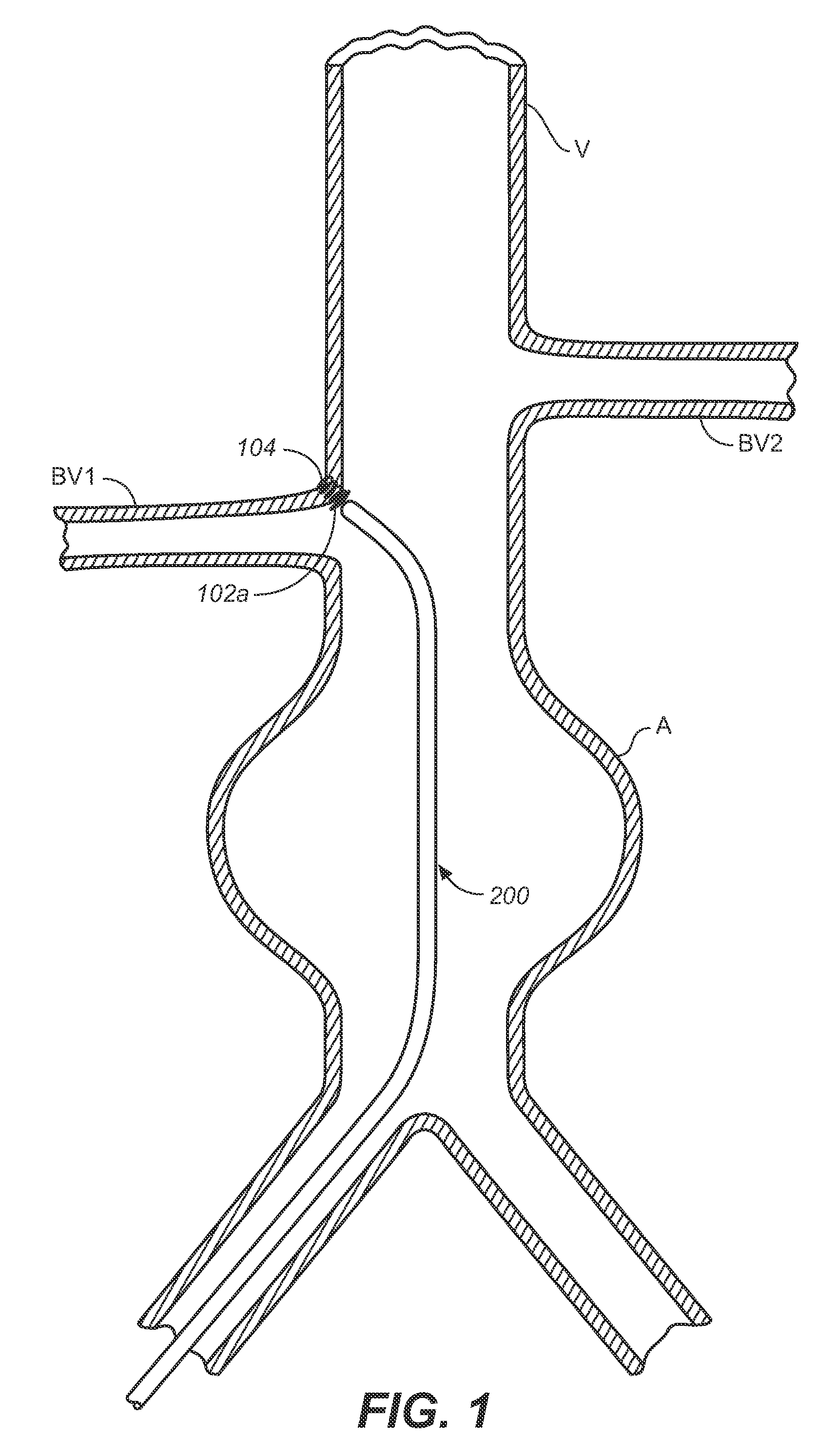 Prosthesis Deployment Apparatus and Methods