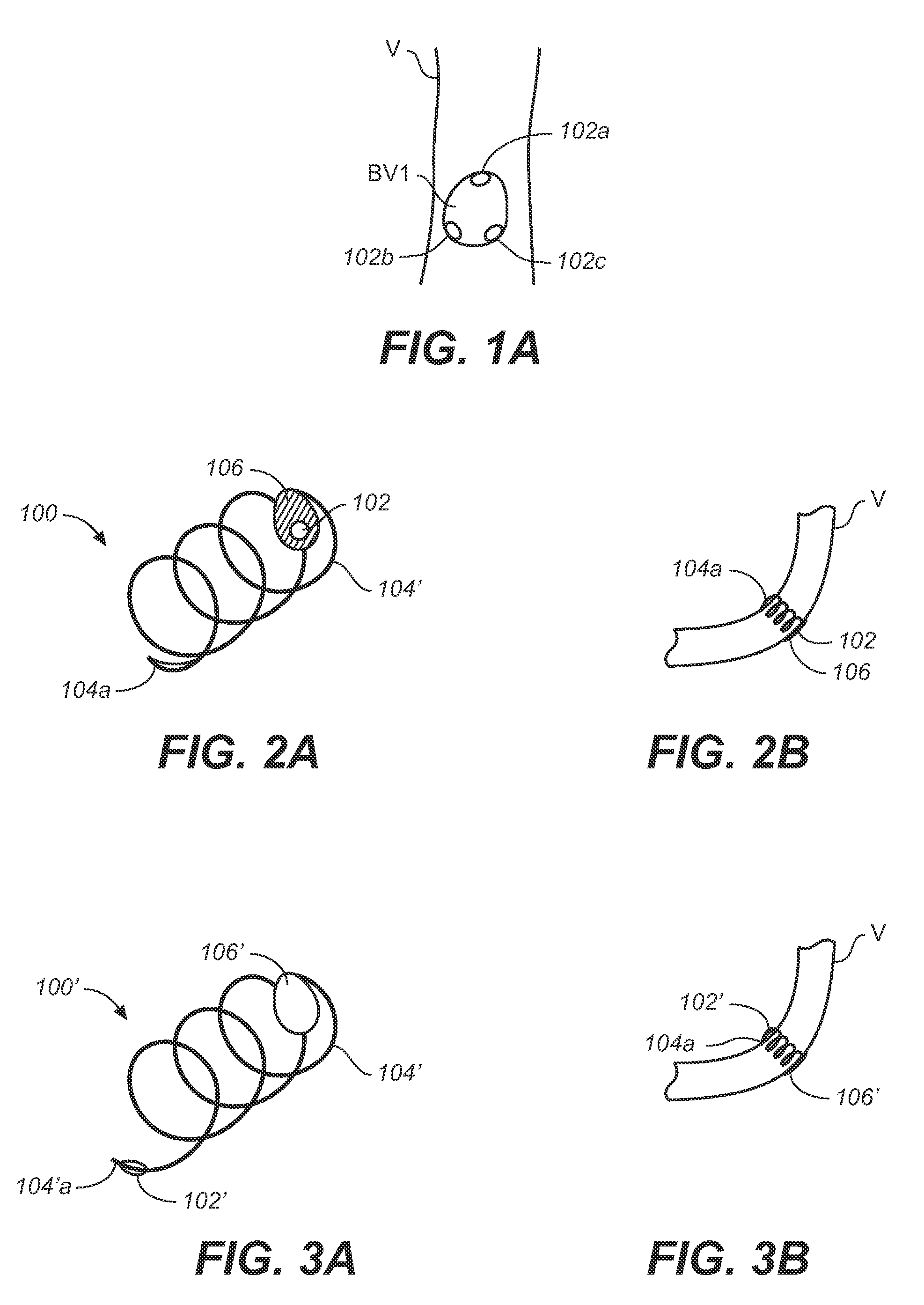 Prosthesis Deployment Apparatus and Methods