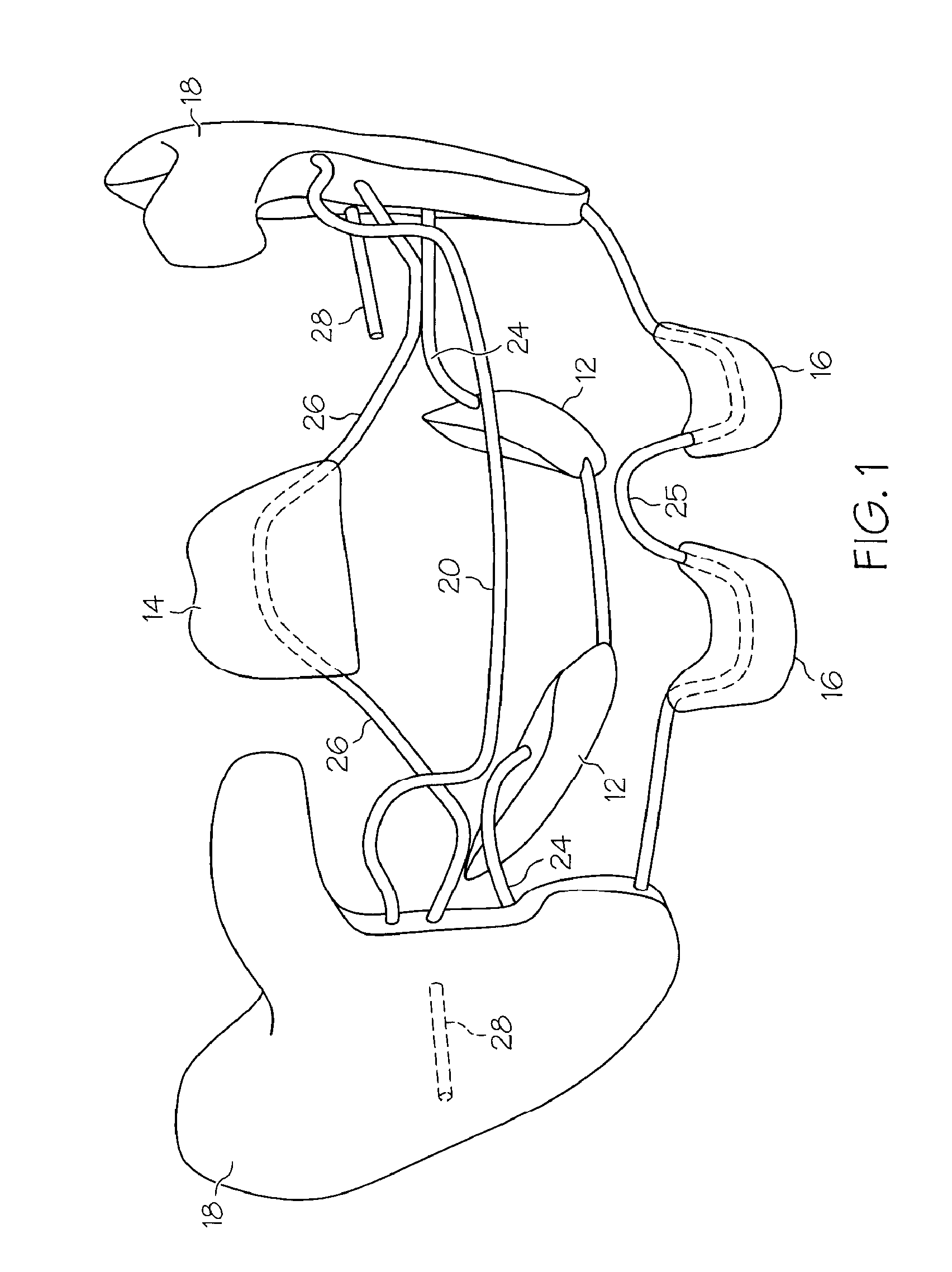 Intraoral apparatus for treating upper airway disorders