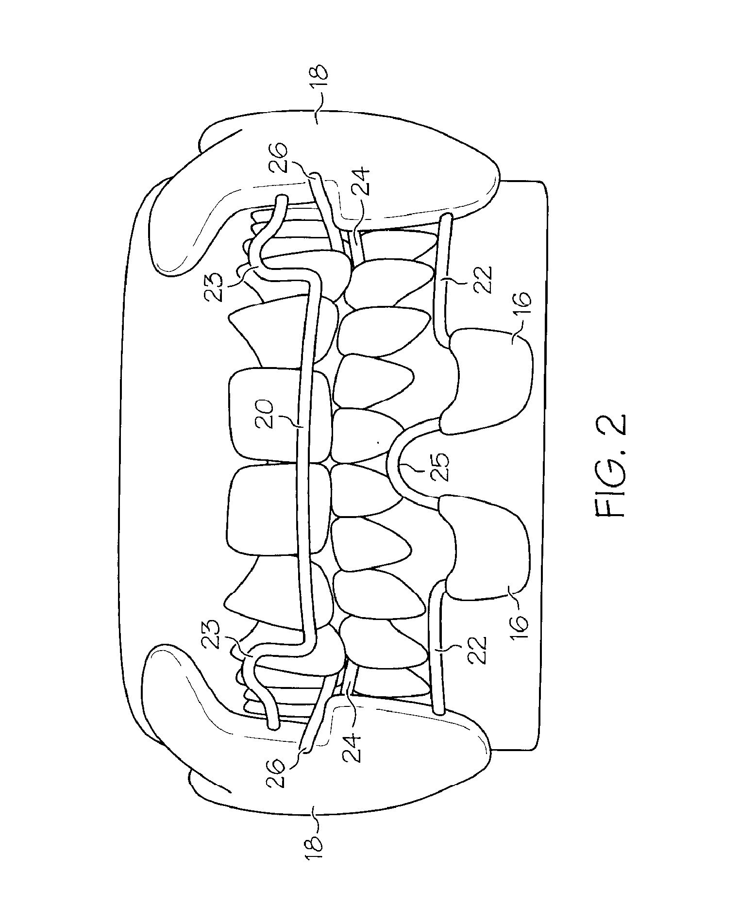 Intraoral apparatus for treating upper airway disorders