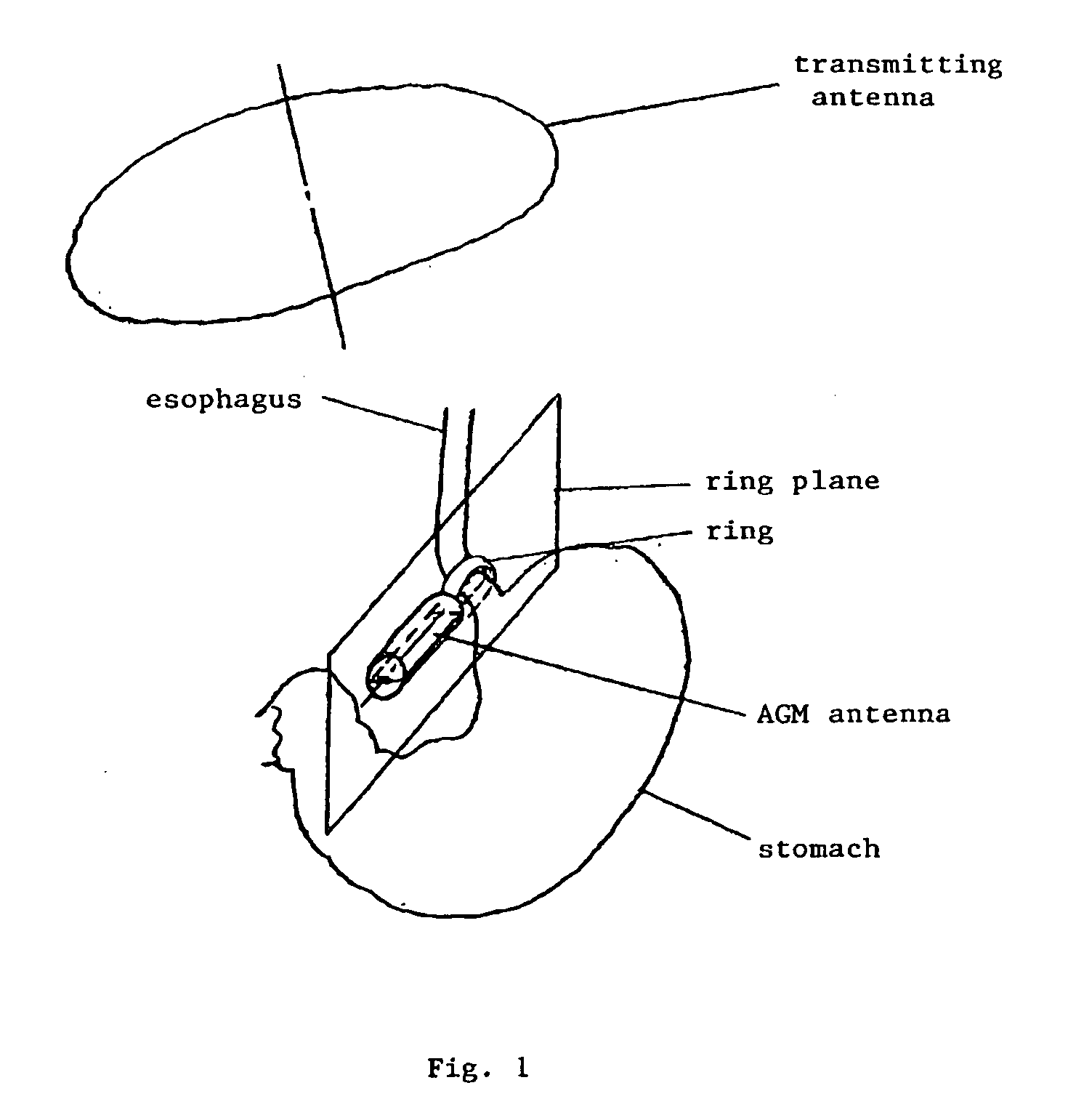 Motor-Operated Gastric Banding Device Or Gastric Ring Comprising At Least One Misaligned Receiving Antenna For Power Supply, Remote Control And Data Transmission By Means Of Induction