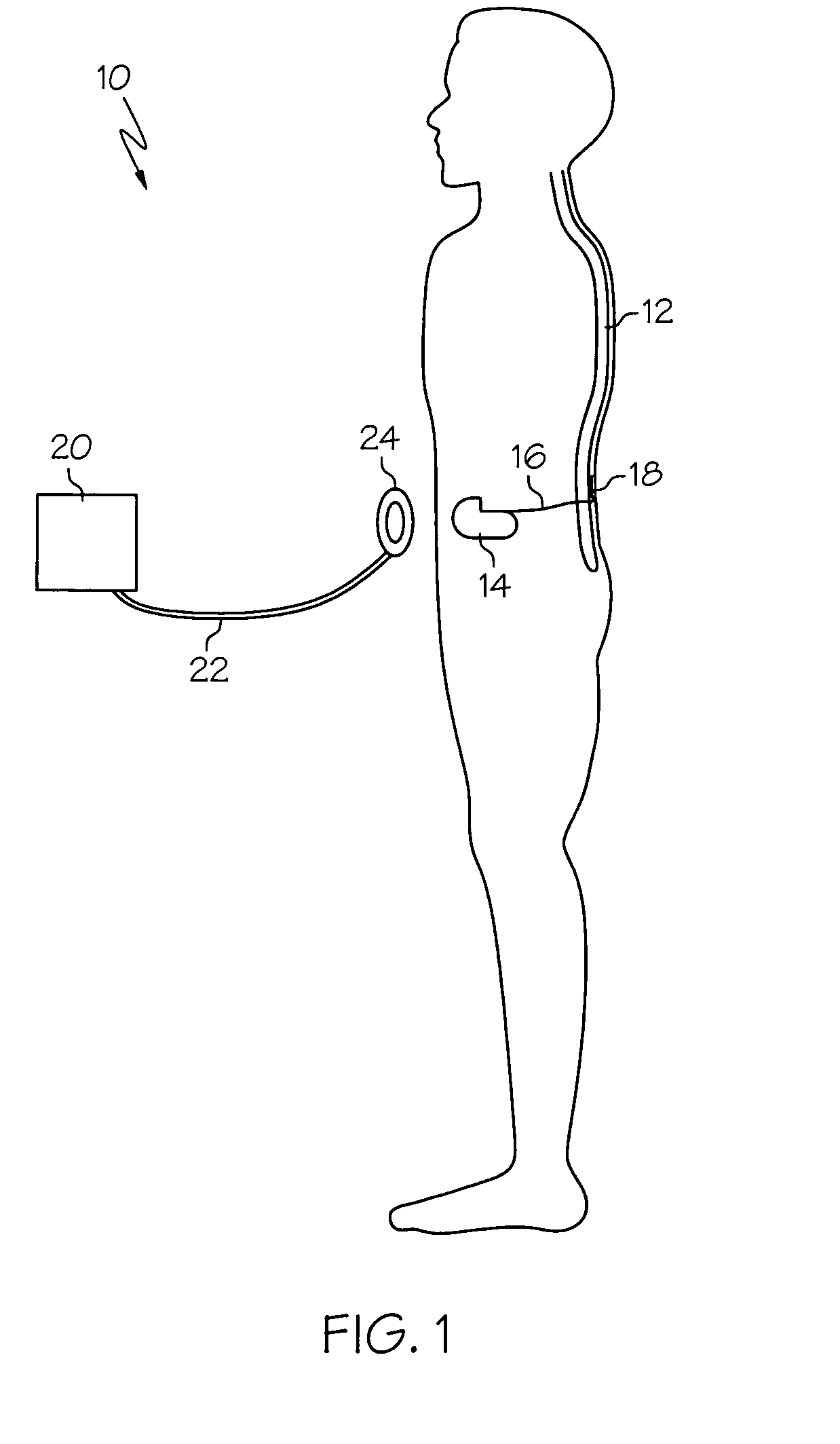Paddle-style medical lead and method