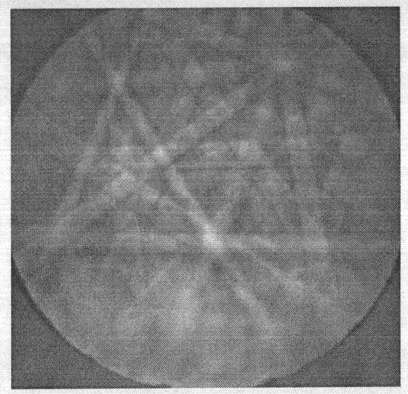 Method of differentiating martensite in cast ferrite stainless steel and calculating martensite -phase contents