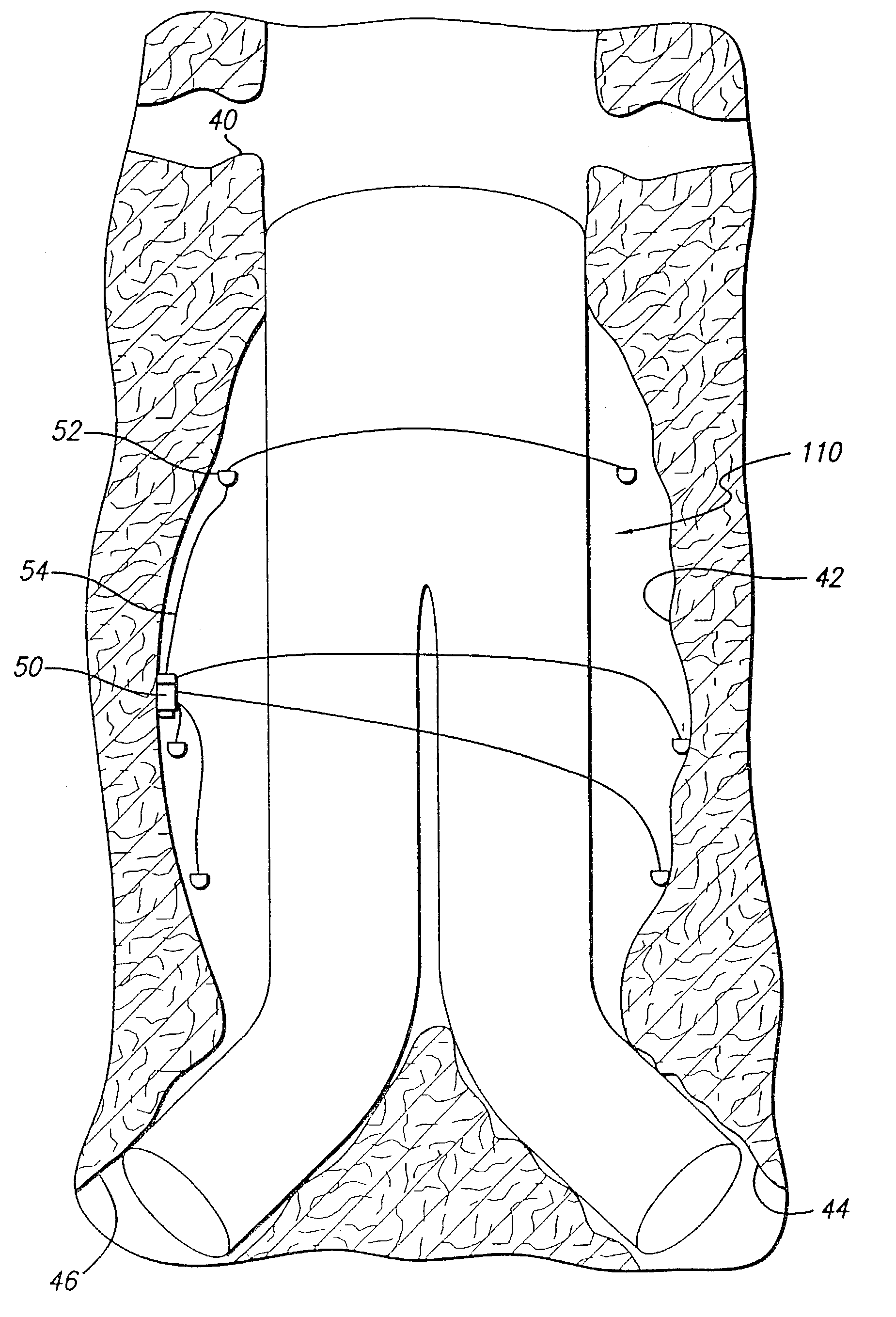 Endovascular graft with separable sensors