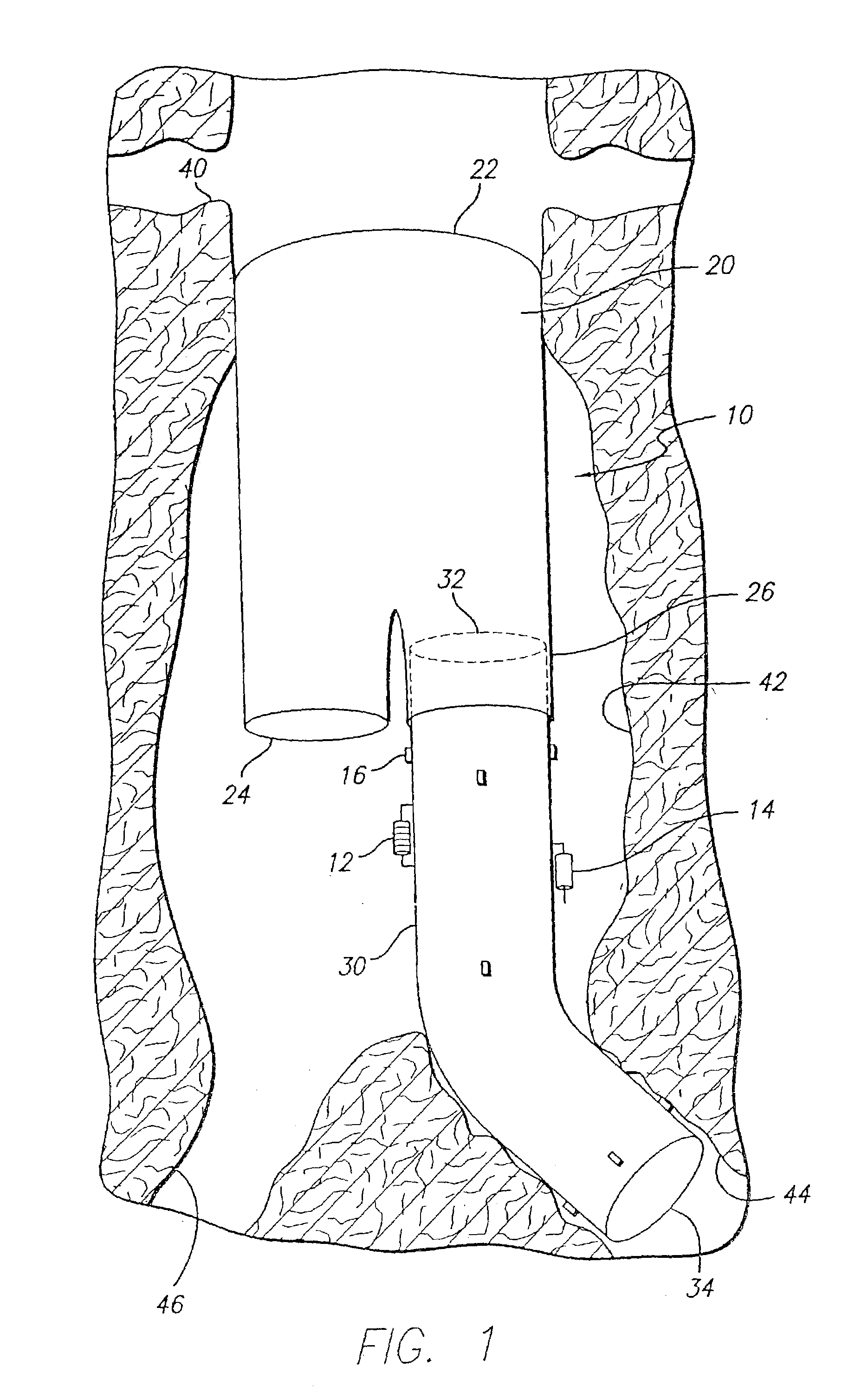 Endovascular graft with separable sensors