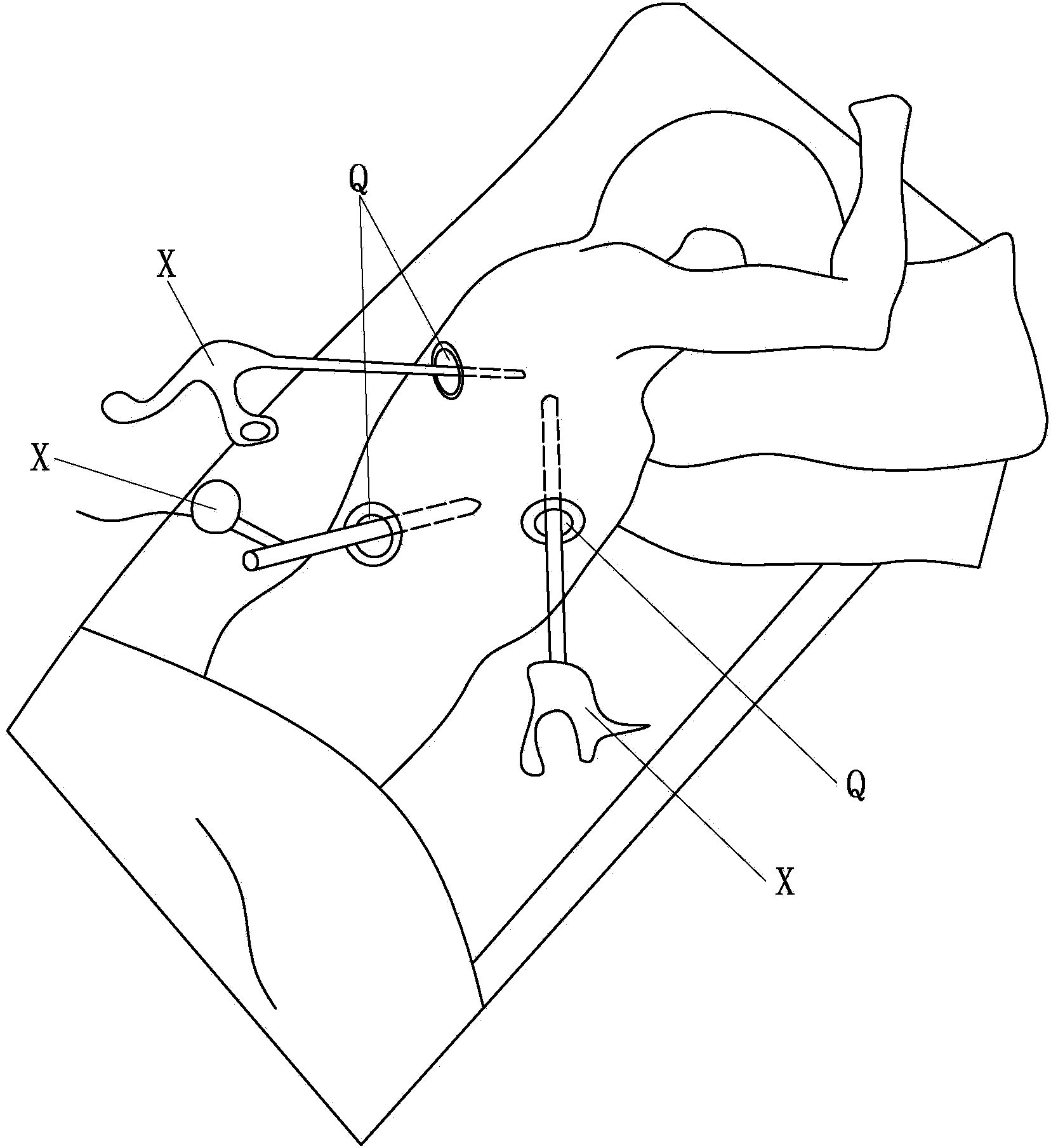 L-shaped video assisted thoracoscopic surgery showing device