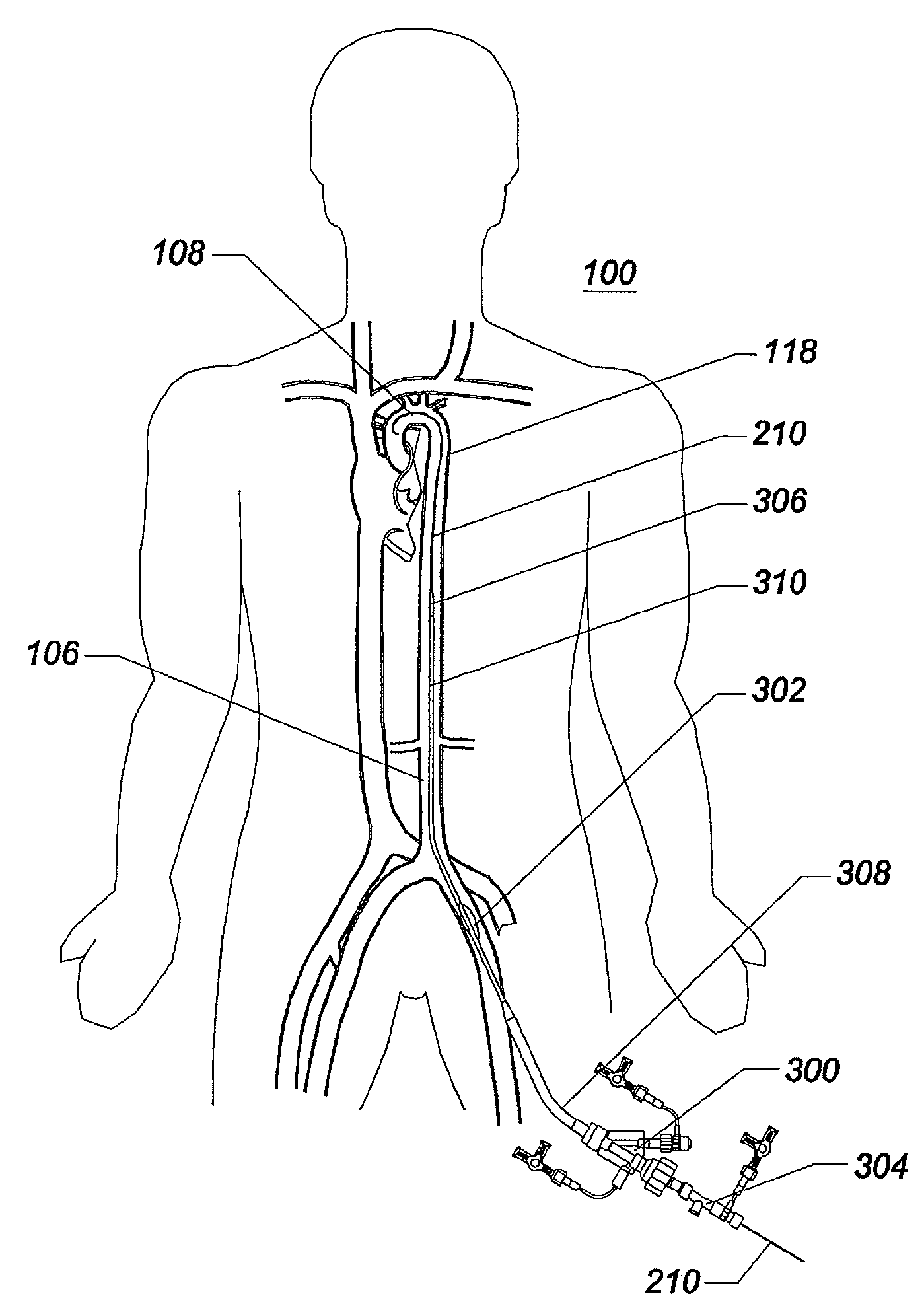 Expandable intra-aortic balloon pump sheath