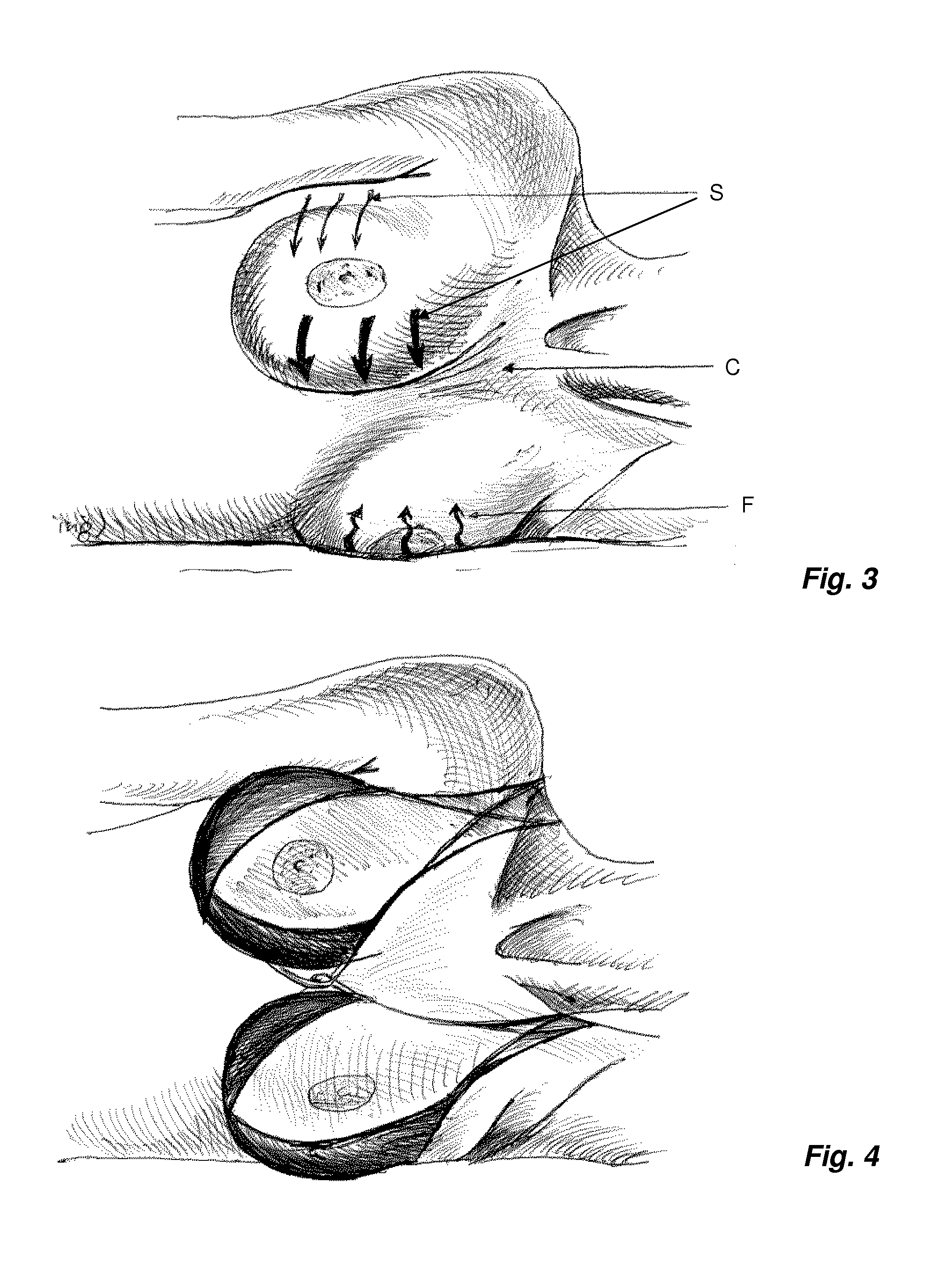 Breast support system for recumbent woman and methods of use