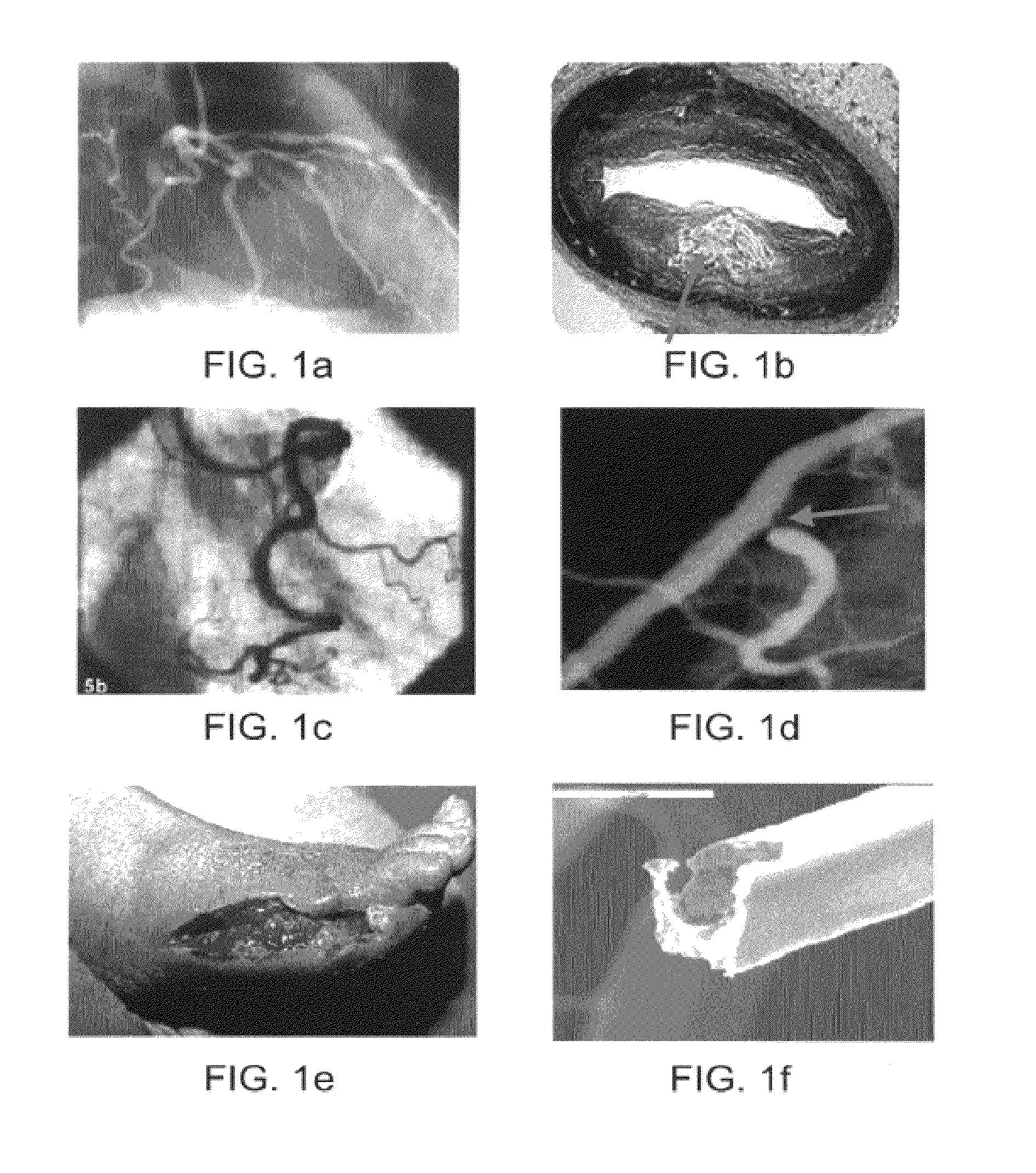 Apparatus and Method for Treatment of In-Stent Restenosis