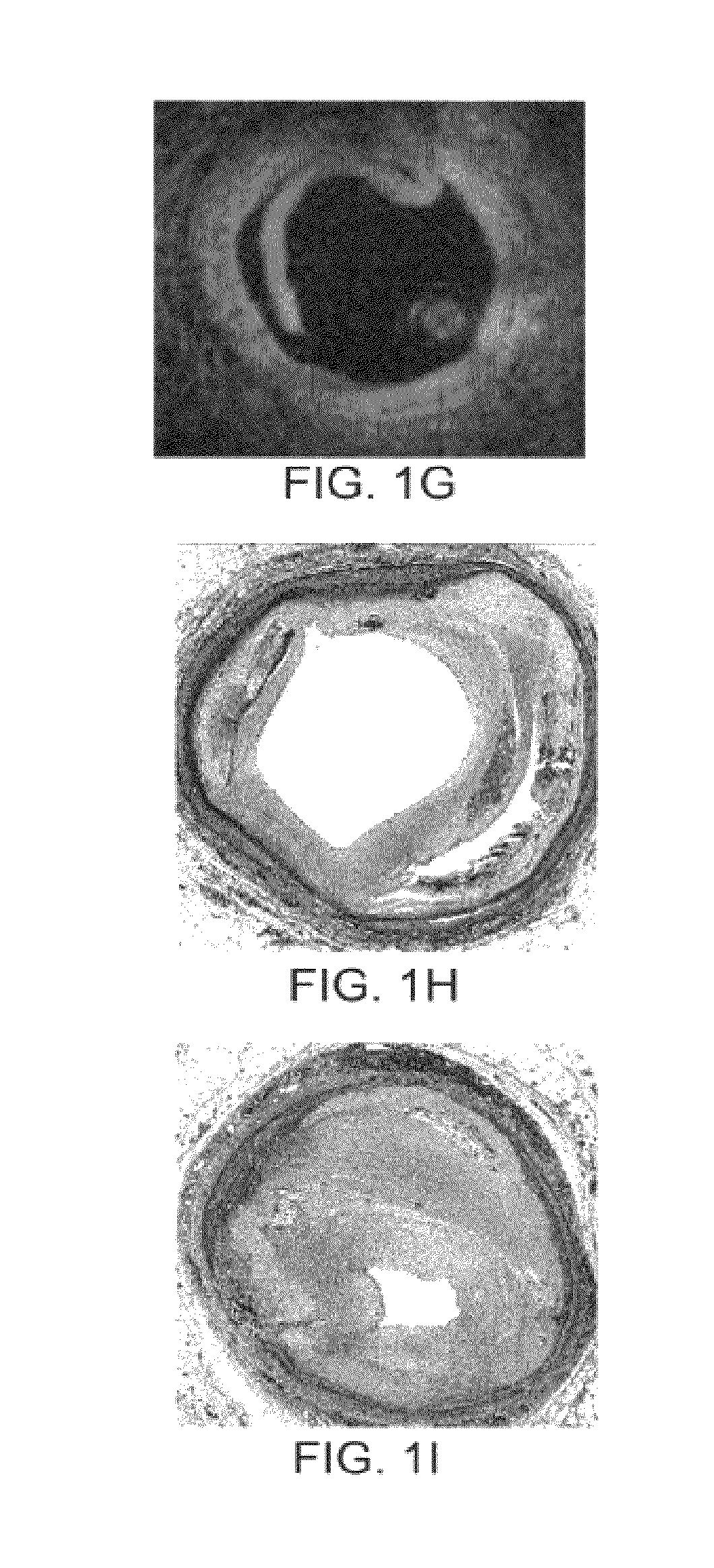 Apparatus and Method for Treatment of In-Stent Restenosis
