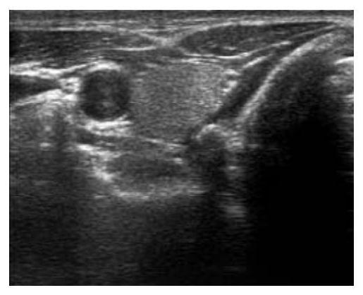 An automatic segmentation method for thyroid ultrasound images based on radial basis neural network