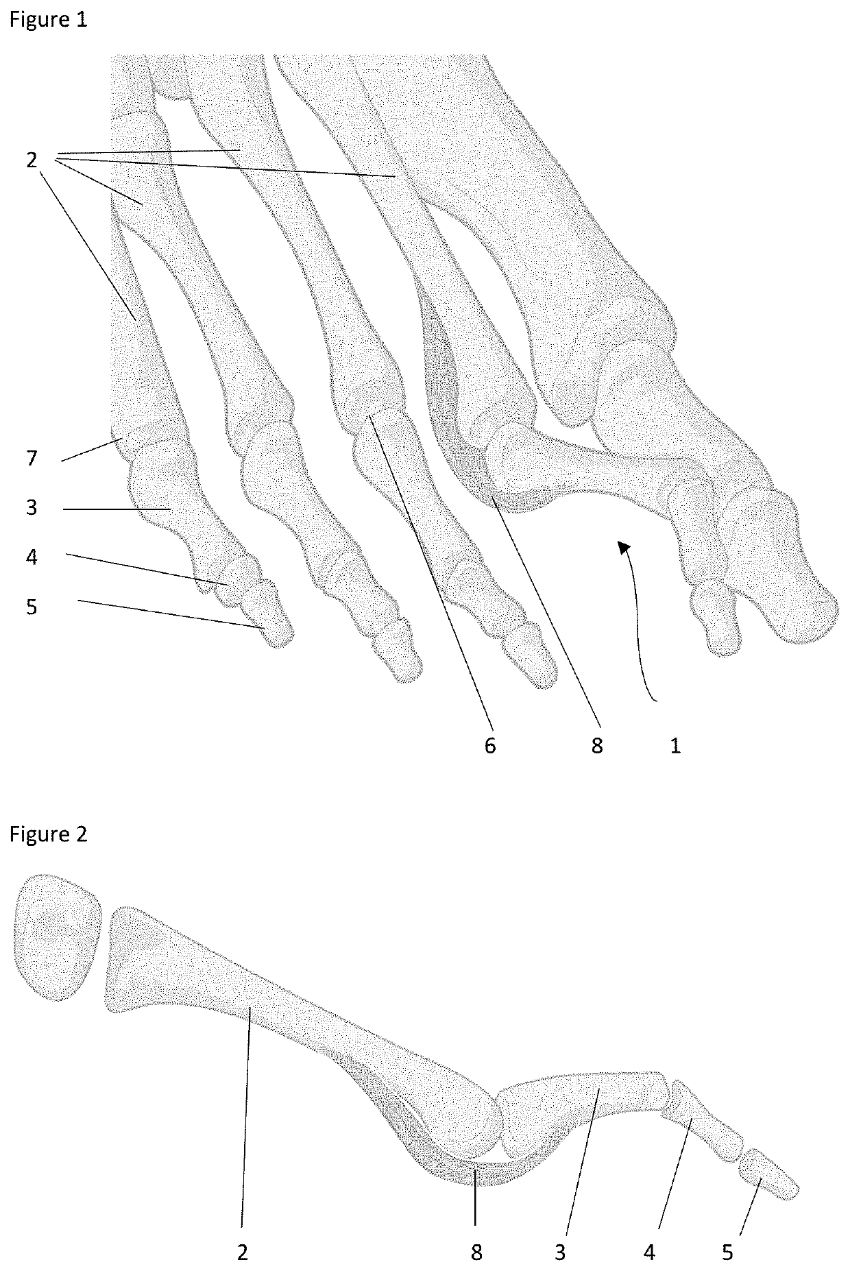 Surgical methods for the treatment of plantar plate injury