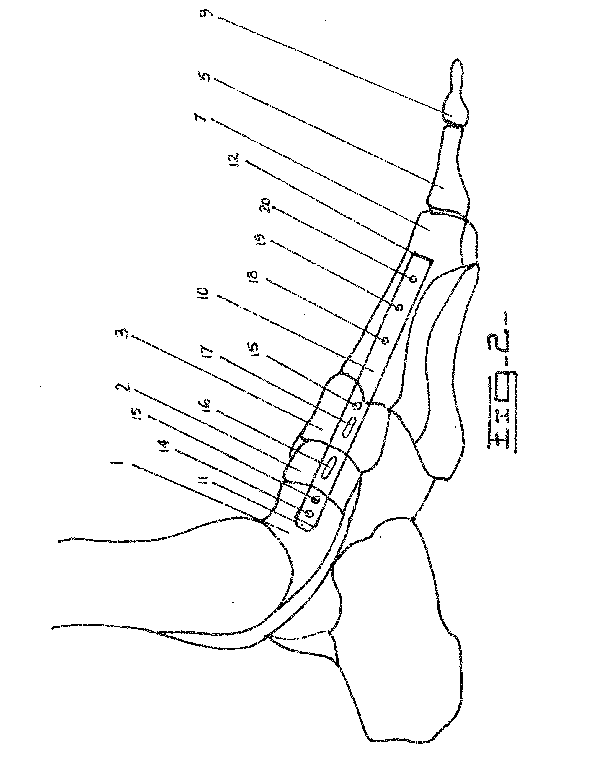 Method and Apparatus for Repairing the Mid-Foot Region Via and Intramedullary Nail