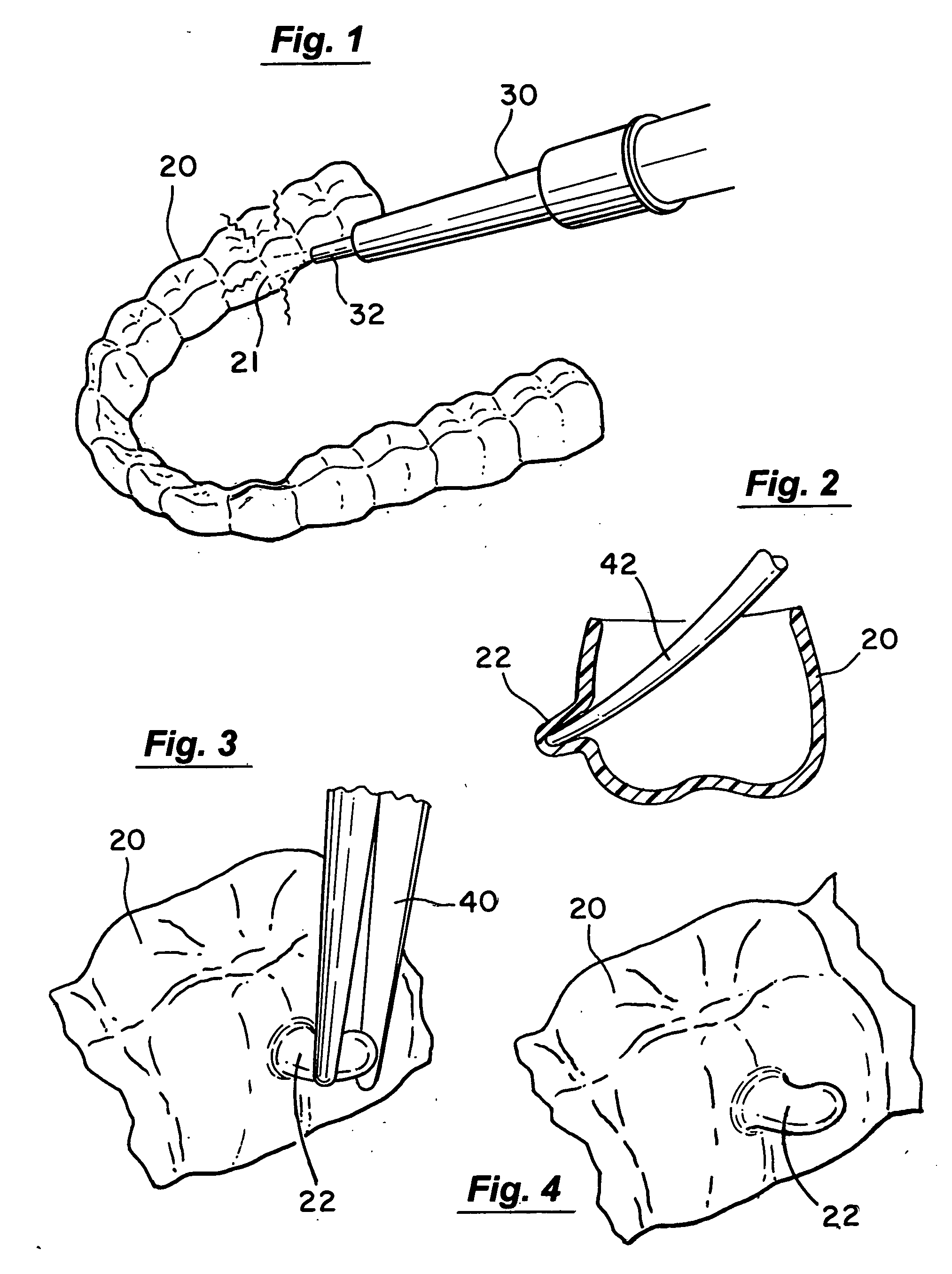 Method for creating features in orthodontic aligners