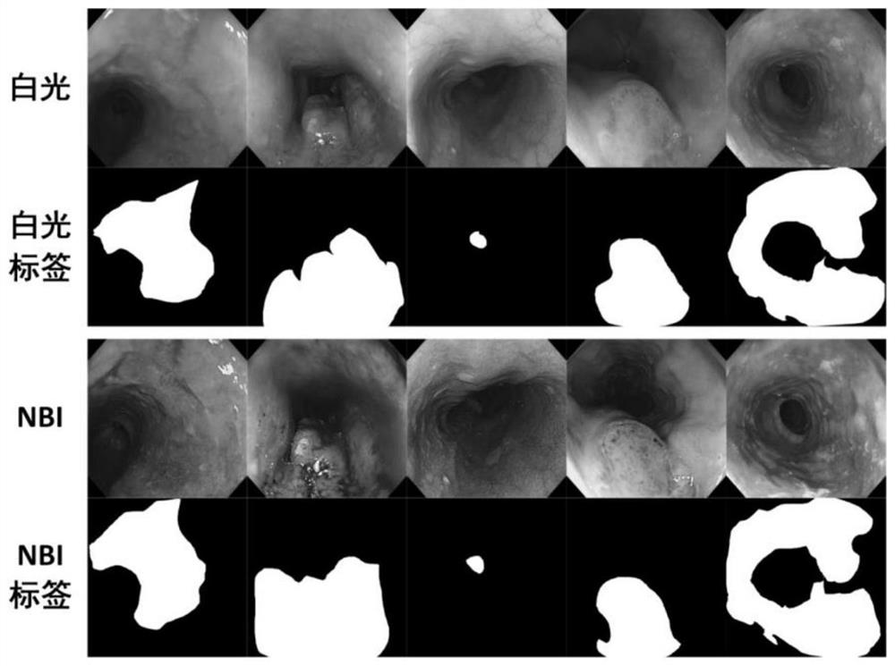 Multi-mode cooperation esophageal cancer lesion image segmentation system based on self-sampling similarity